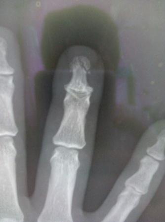 这手指骨折算是愈合不良吧 医学影像学讨论版 爱爱医医学论坛