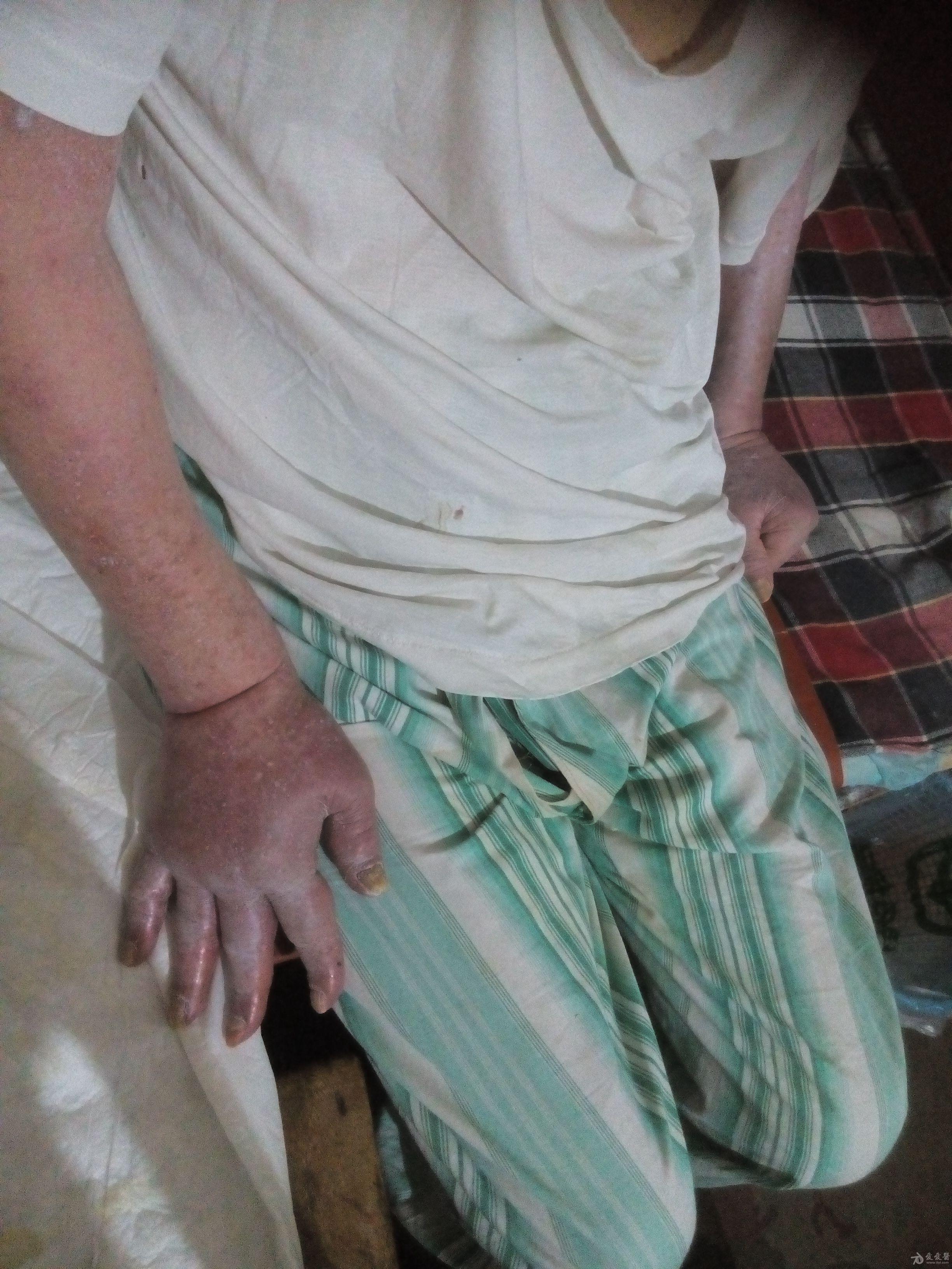 求指点我父亲左脑出血中风22年右侧受限最近患侧手肿湿疹手内腕因痒已