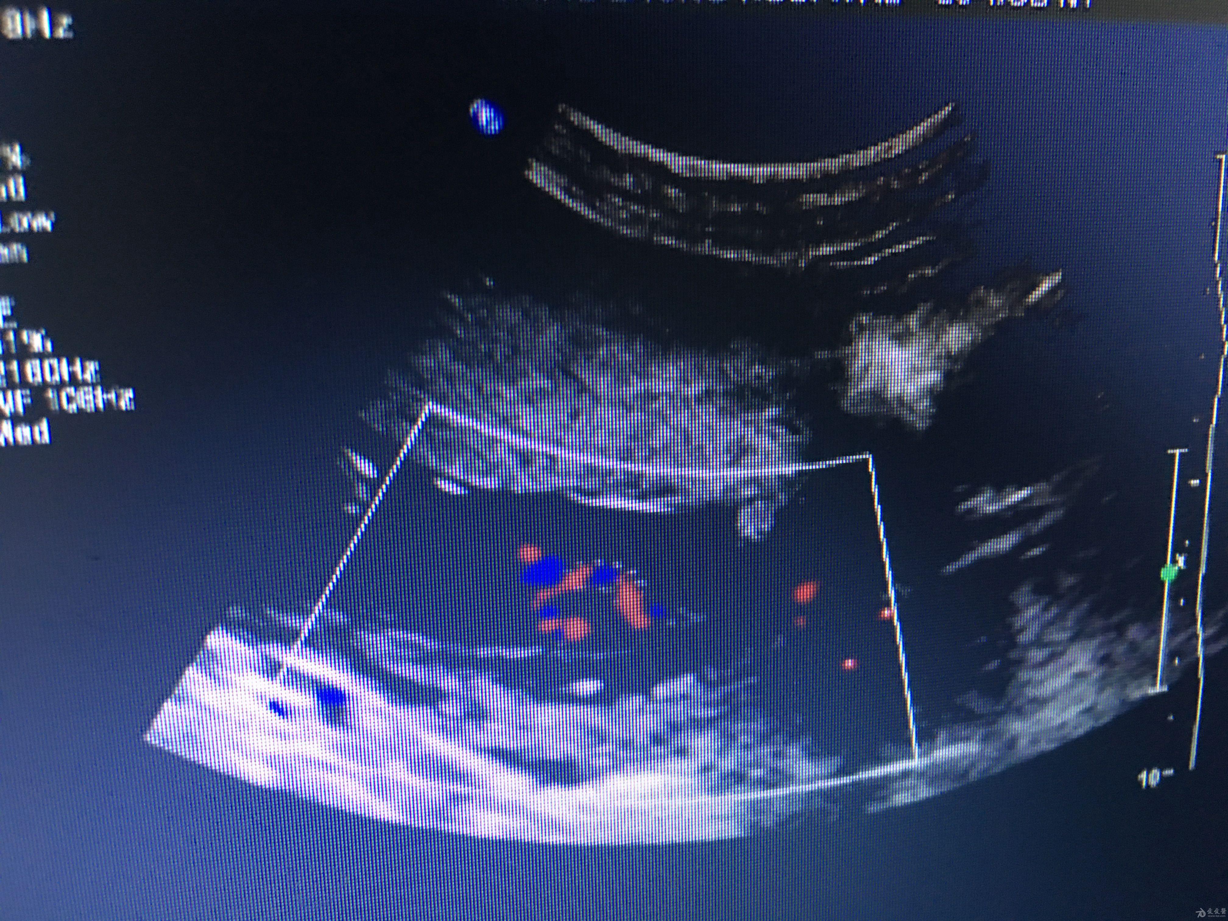 帆状胎盘超声图图片