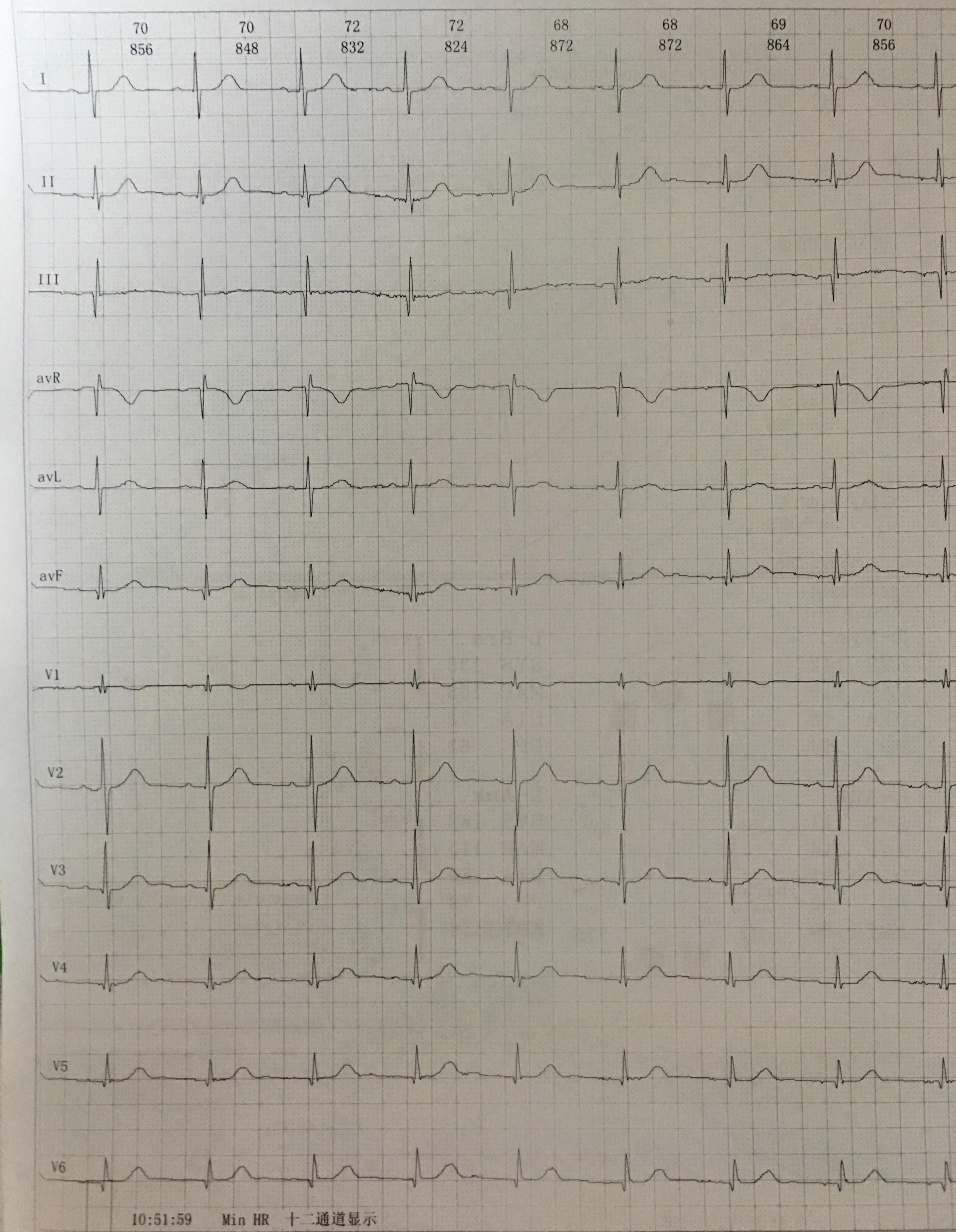 窦房结心电图特征图片