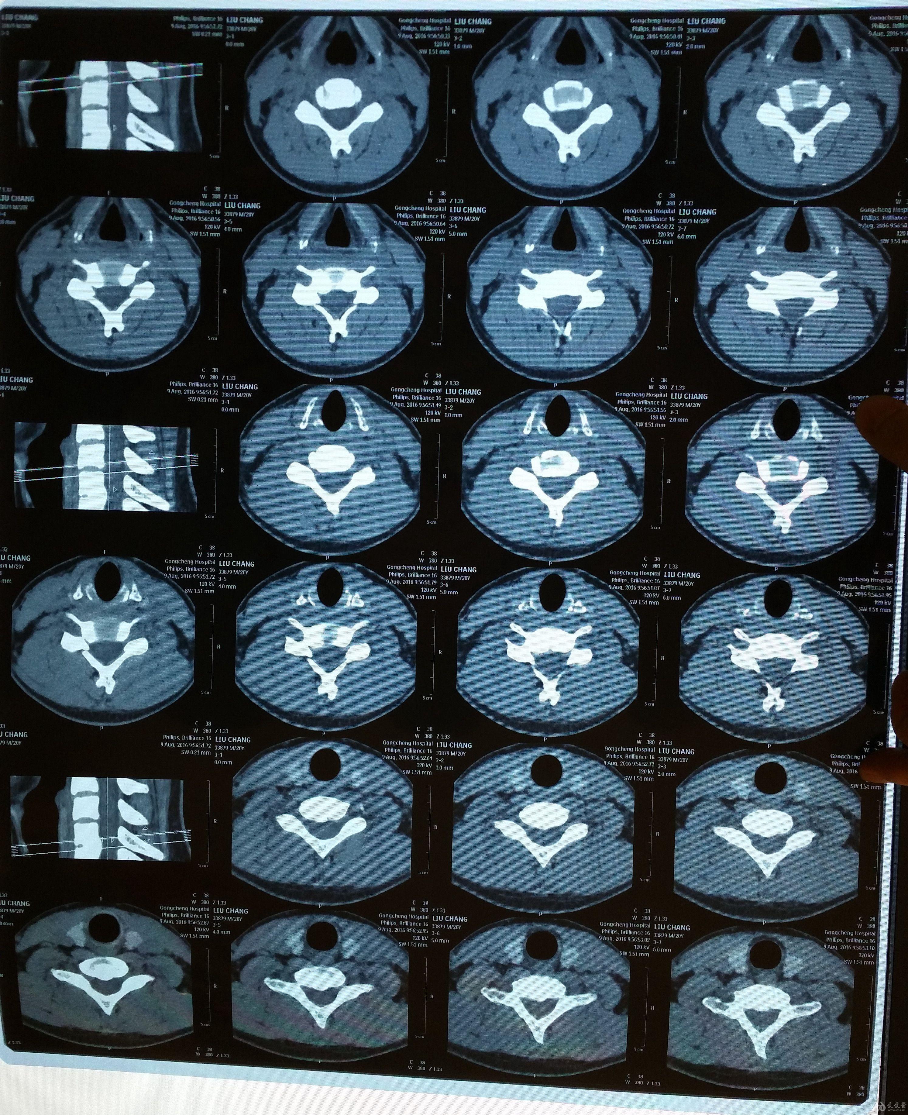 手掌和手指疼了一整晚颈椎平扫如图