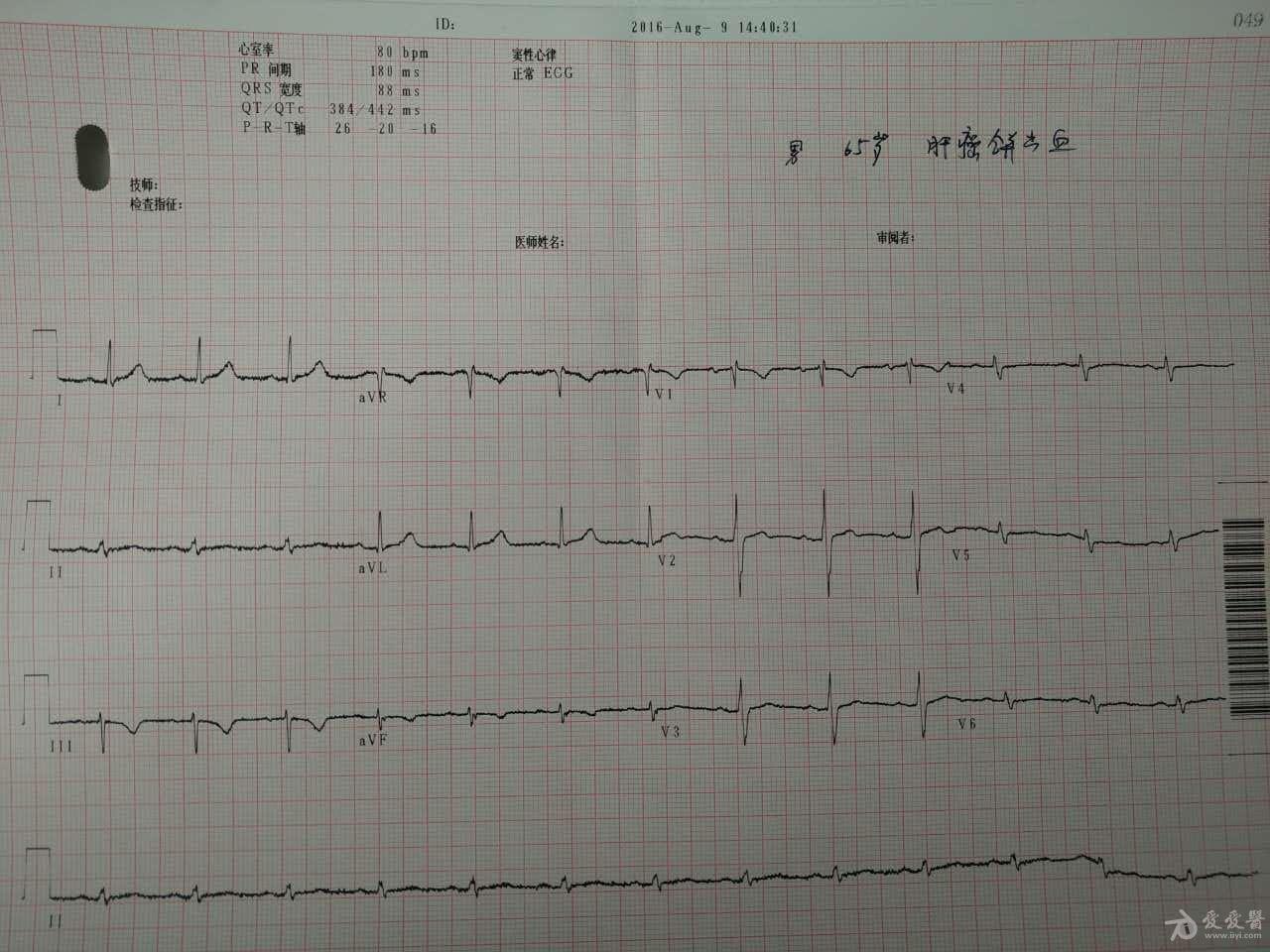 st压低心电图图片