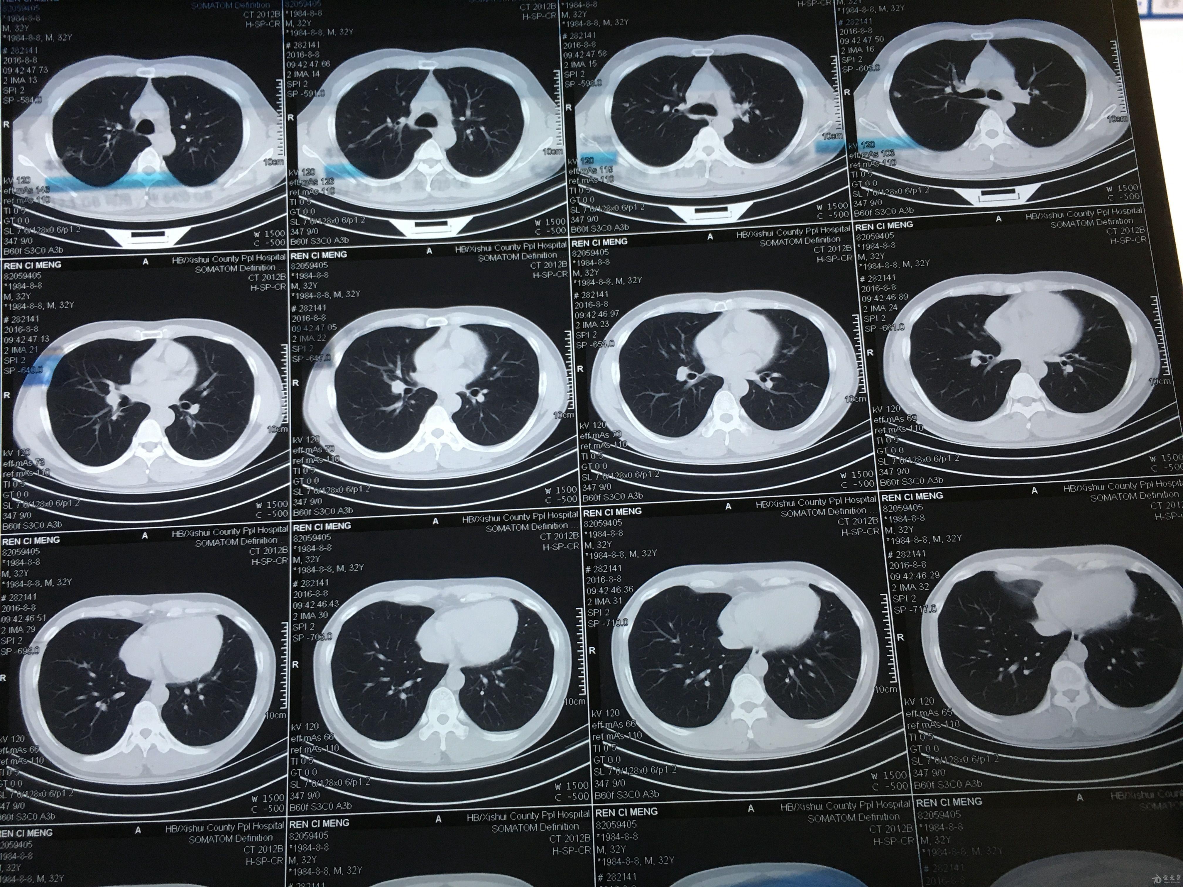 肺结核CT片图片