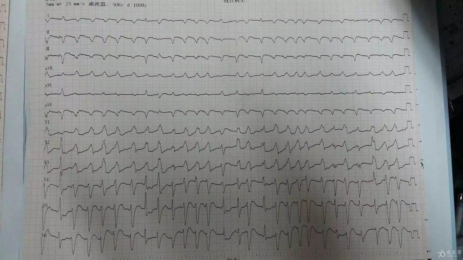 右室流出道室速心电图图片