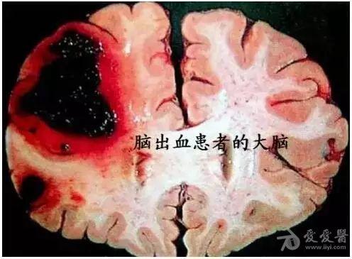 脑梗死,脑血栓及脑出血的区别