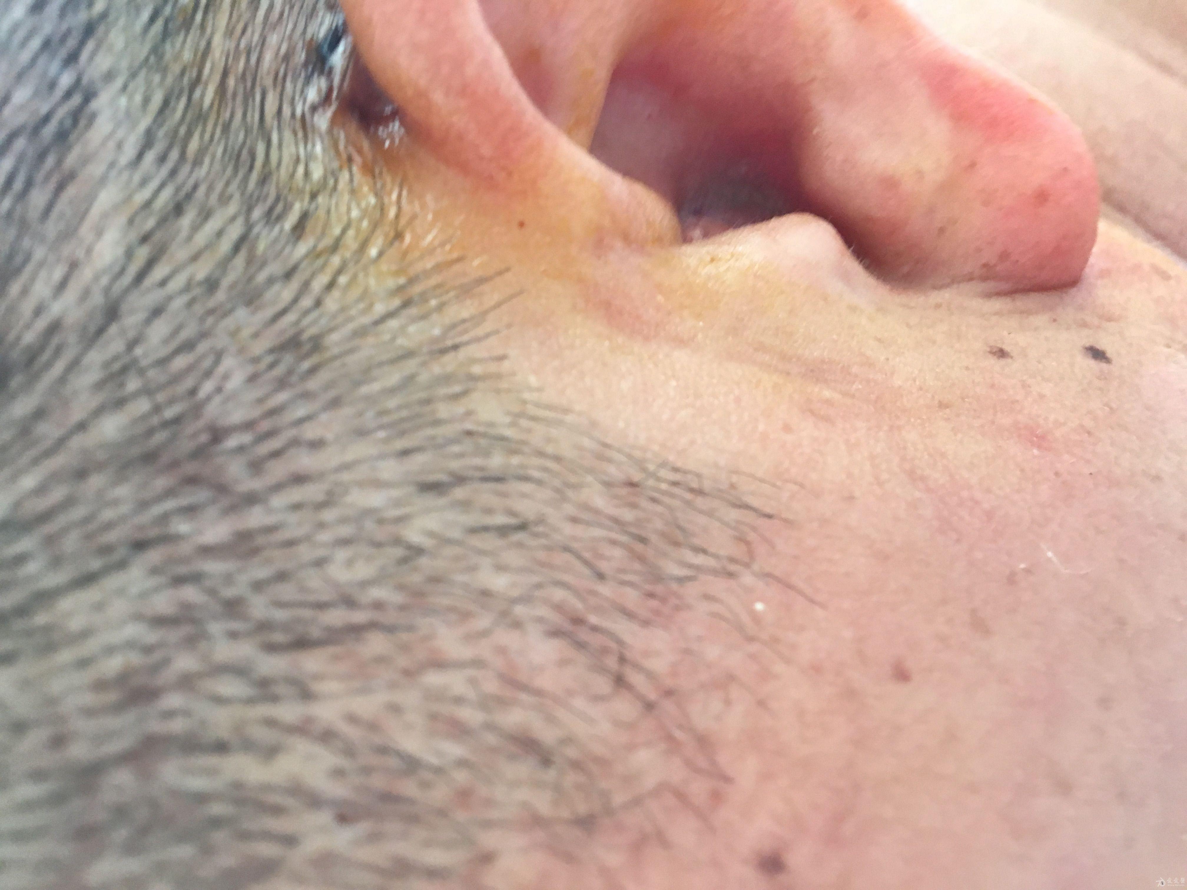 外耳道充血图片