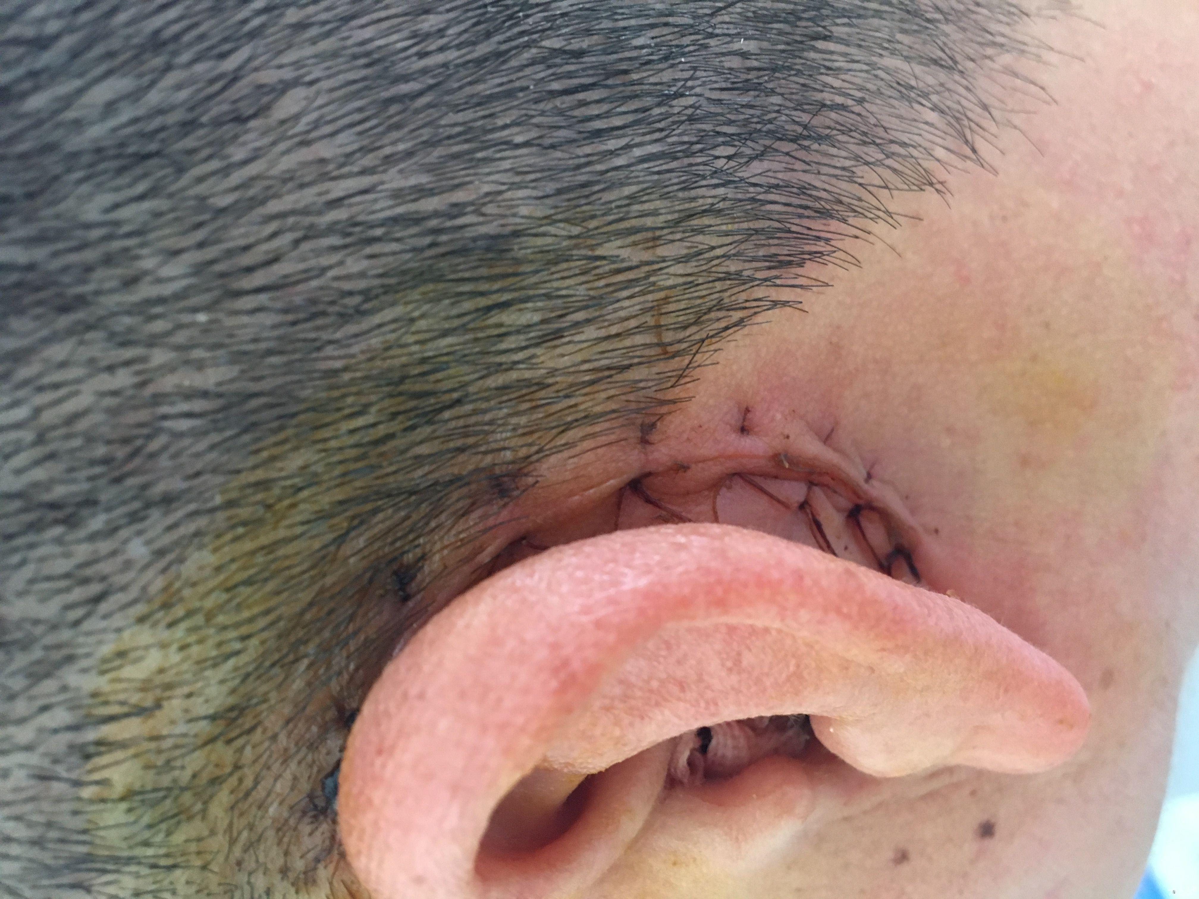 左侧耳鸣9个月外耳道流带血脓性分泌物10余天