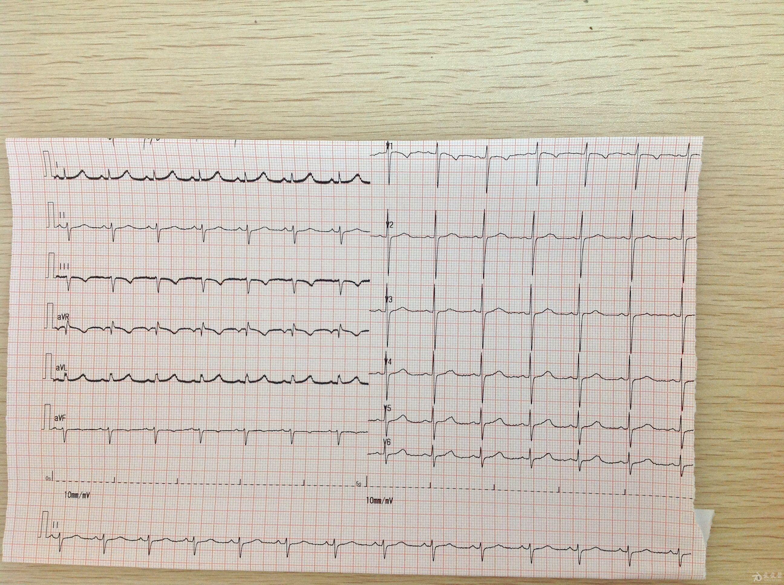心电图轻度t波改变图片