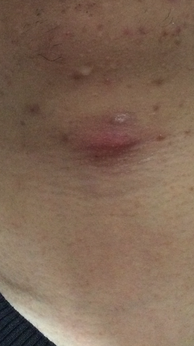 脖子喉咙处长了疙瘩碰到会疼