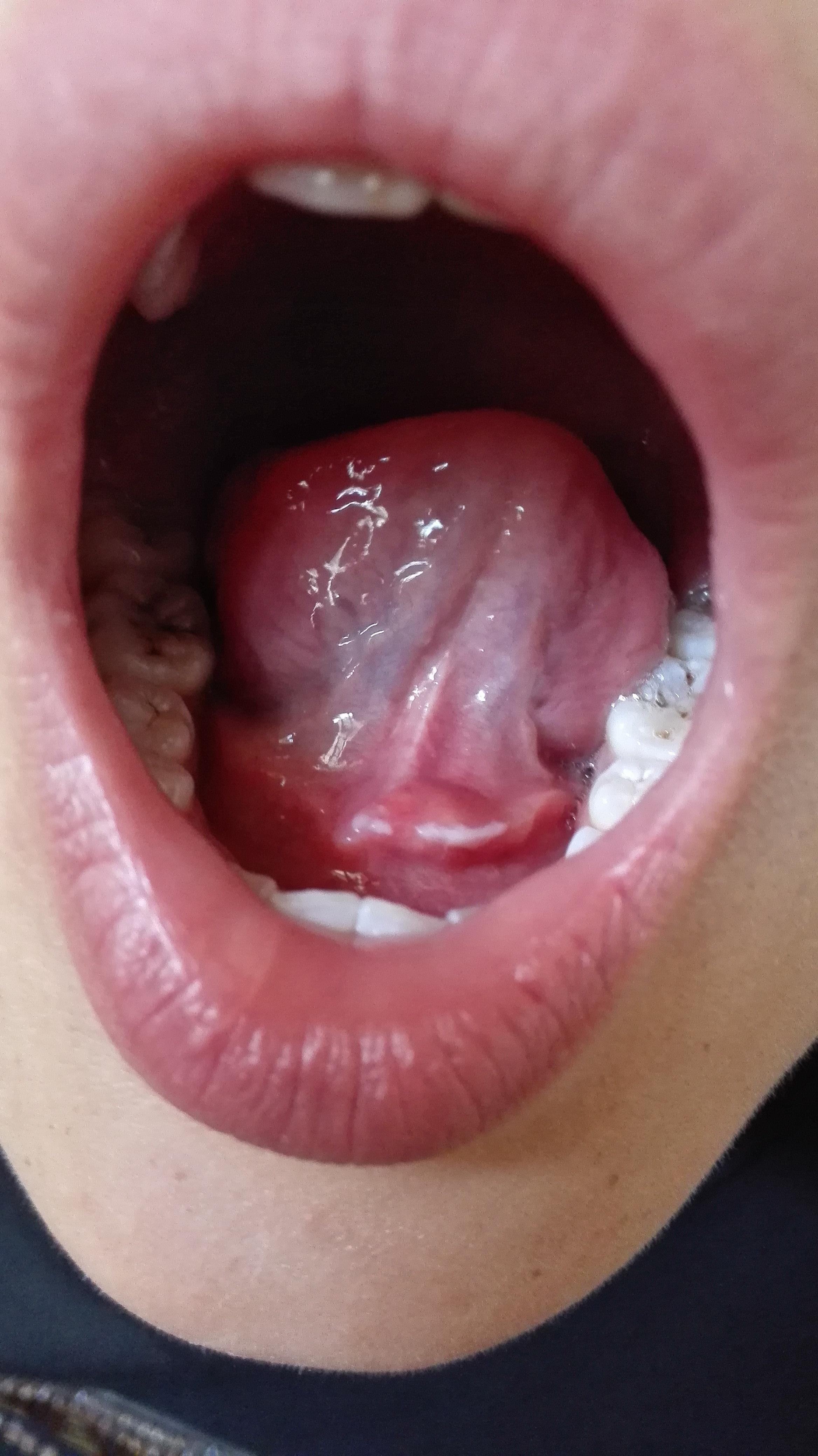 舌下埠正常图片图片