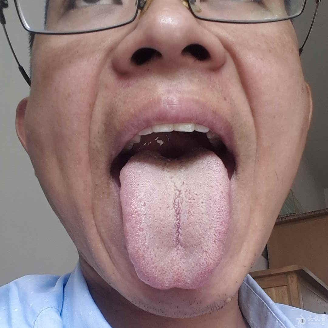 肾病舌头的症状图片图片