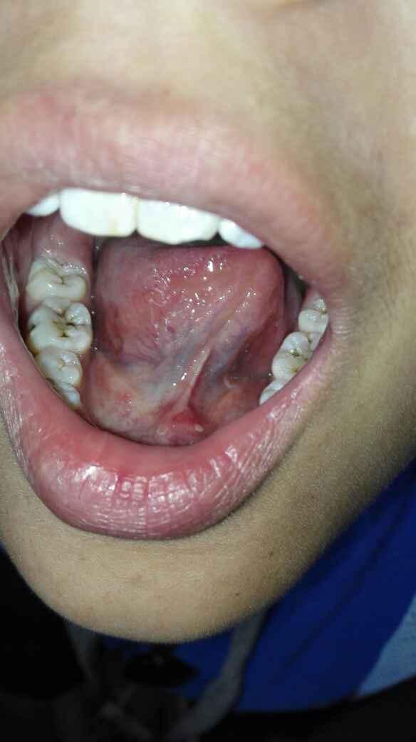 舌下腺发炎图片