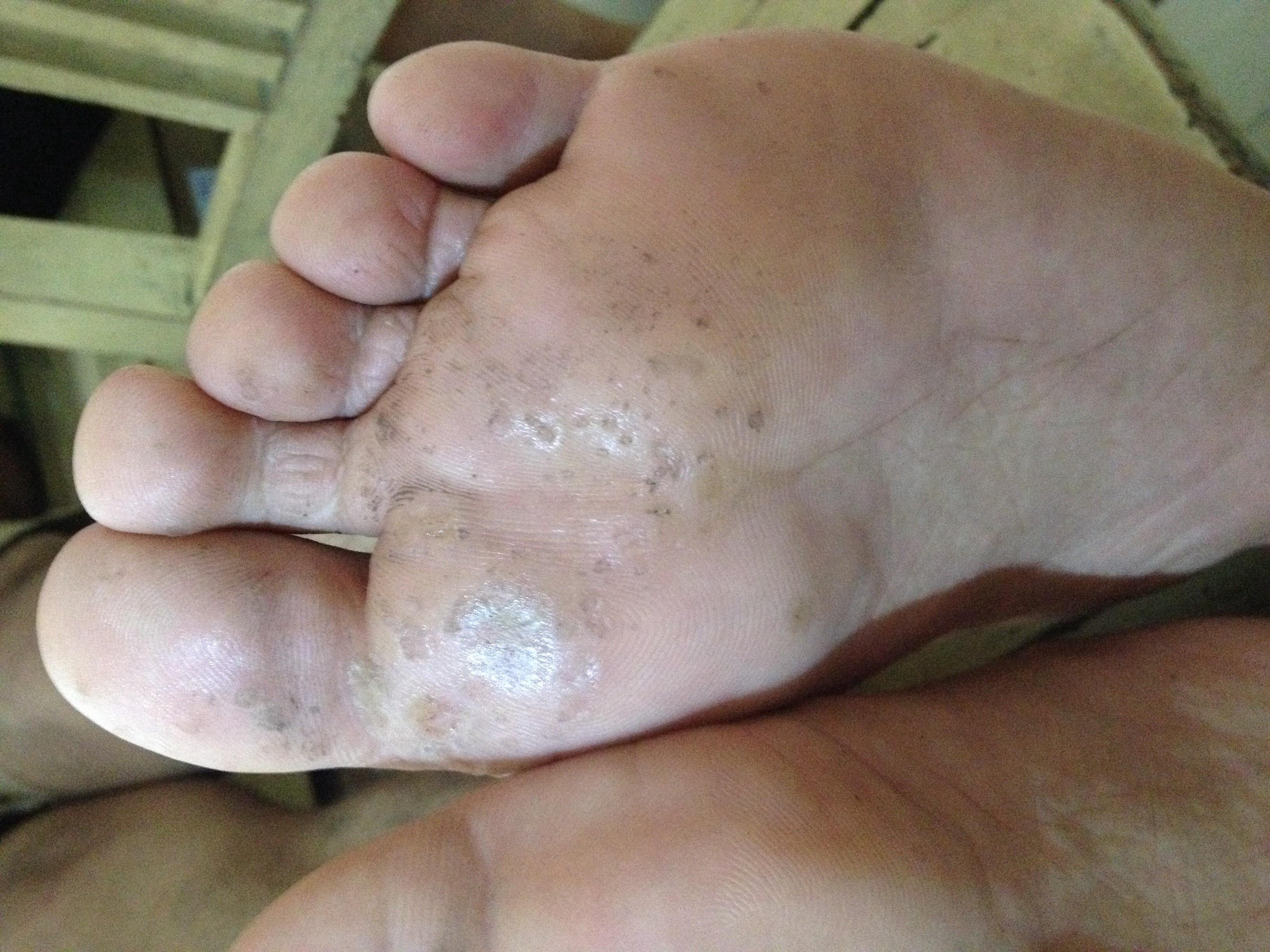 典型病例分享跖疣