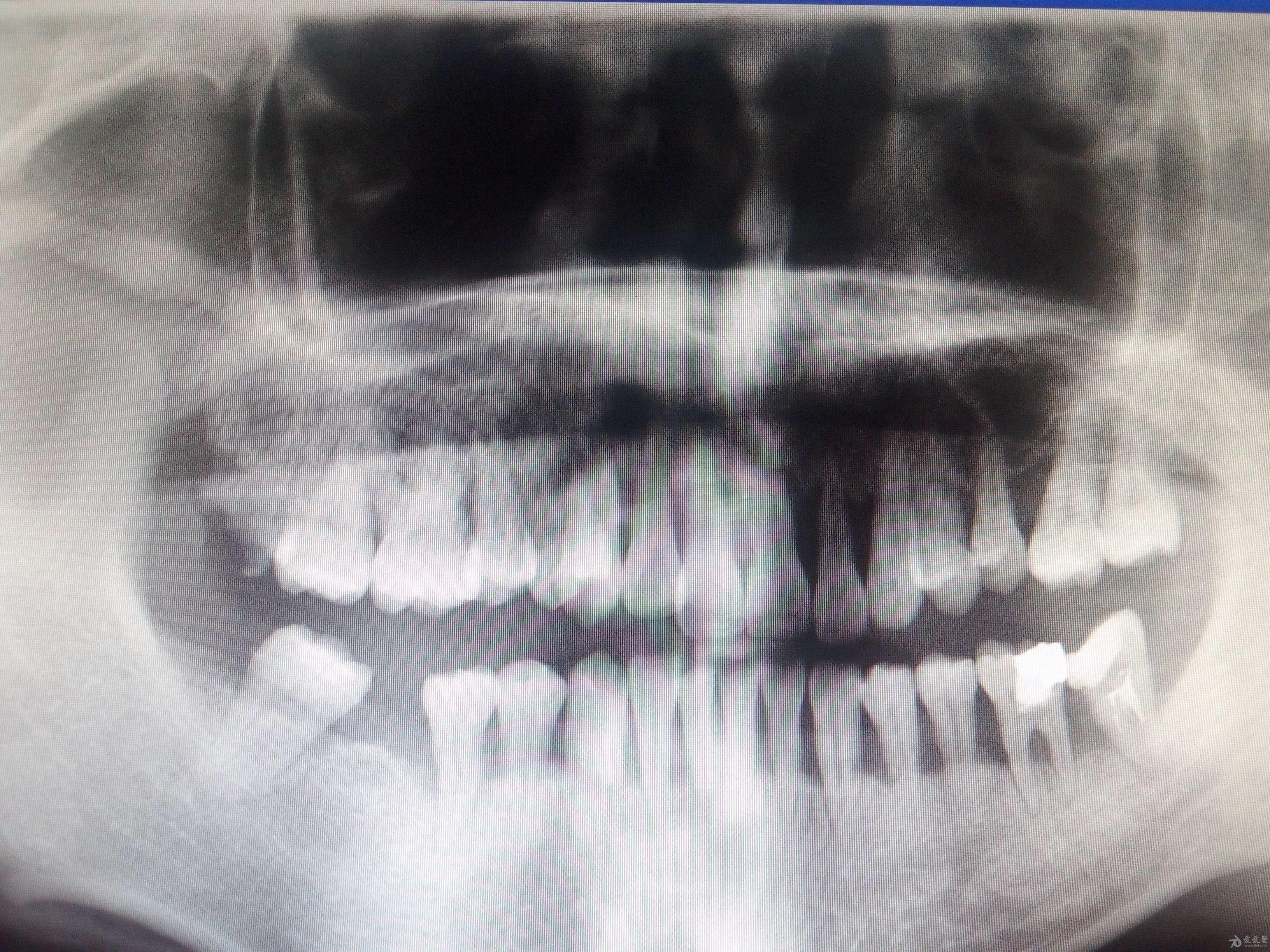 今天去拍了牙片感觉人生已经没意义了