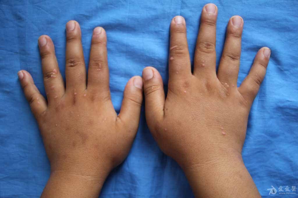 儿童病毒性疣早期图片图片