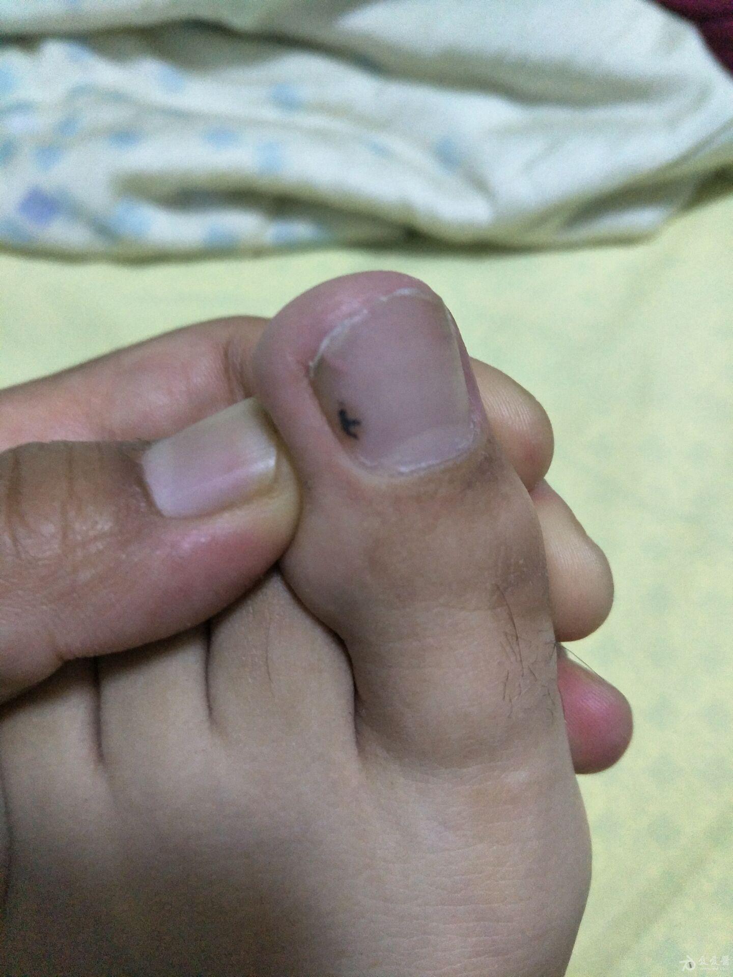 黑素瘤指甲图片
