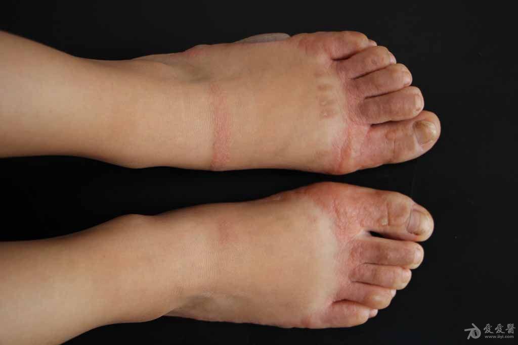 皮肤及性传播疾病讨论版 - 爱爱医医学论坛