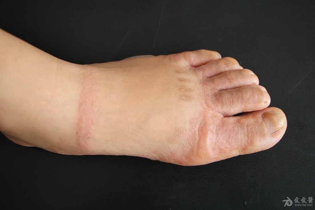 皮肤及性传播疾病讨论版 - 爱爱医医学论坛