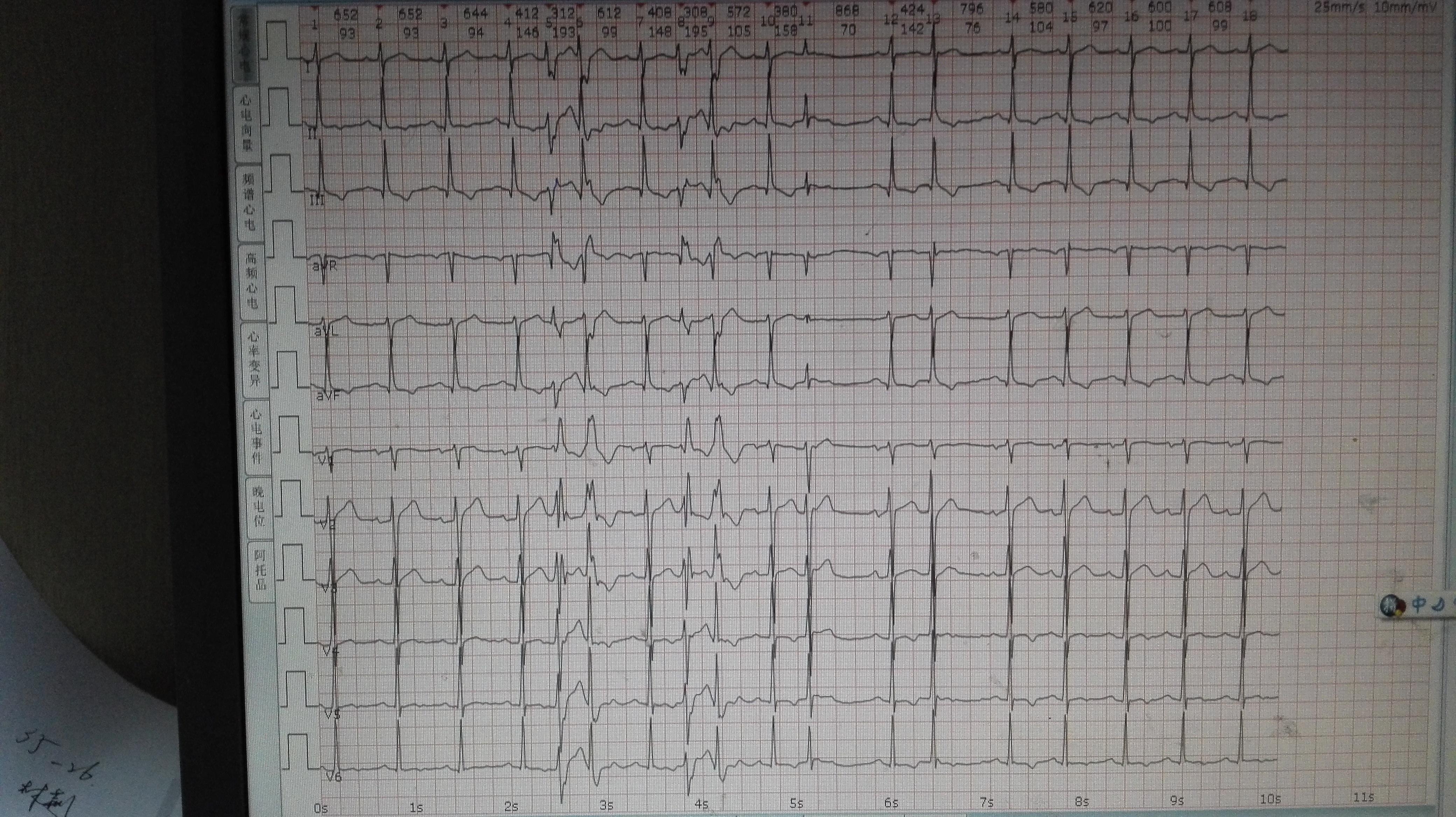 交界早 - 心電圖腦電圖專業討論版 - 愛愛醫醫學論壇