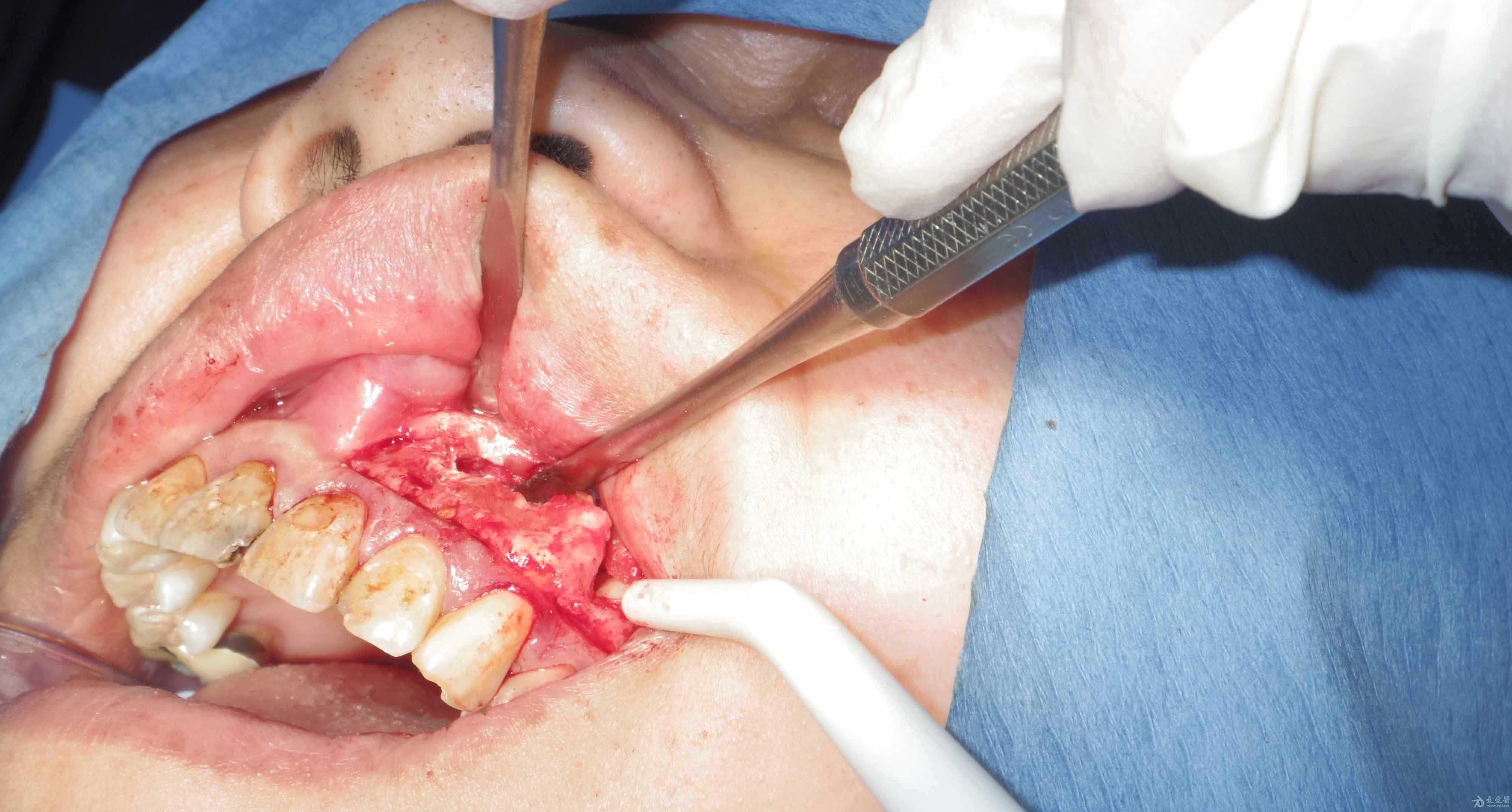 222324根尖切除术及大范围补骨