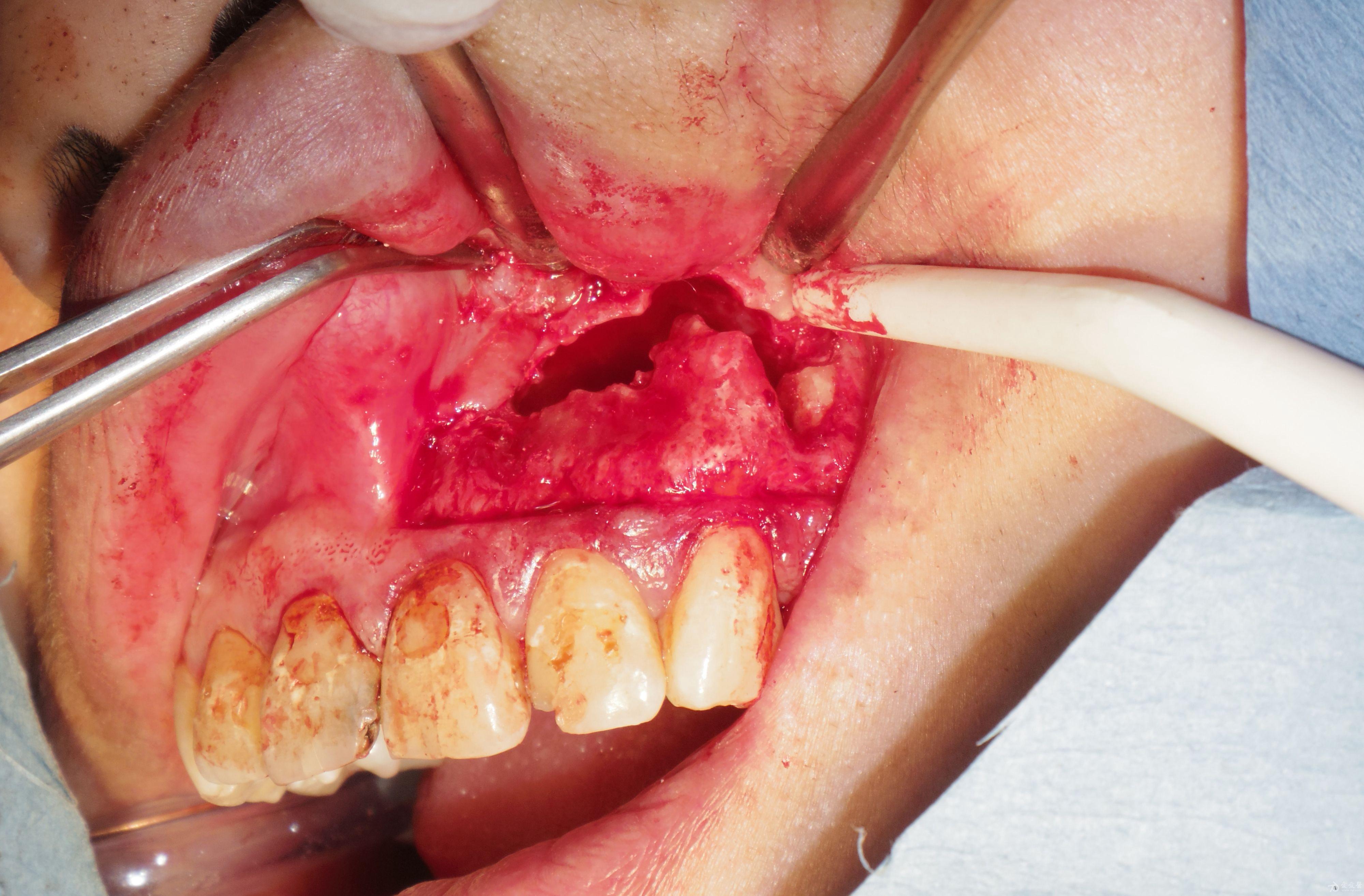 222324根尖切除术及大范围补骨