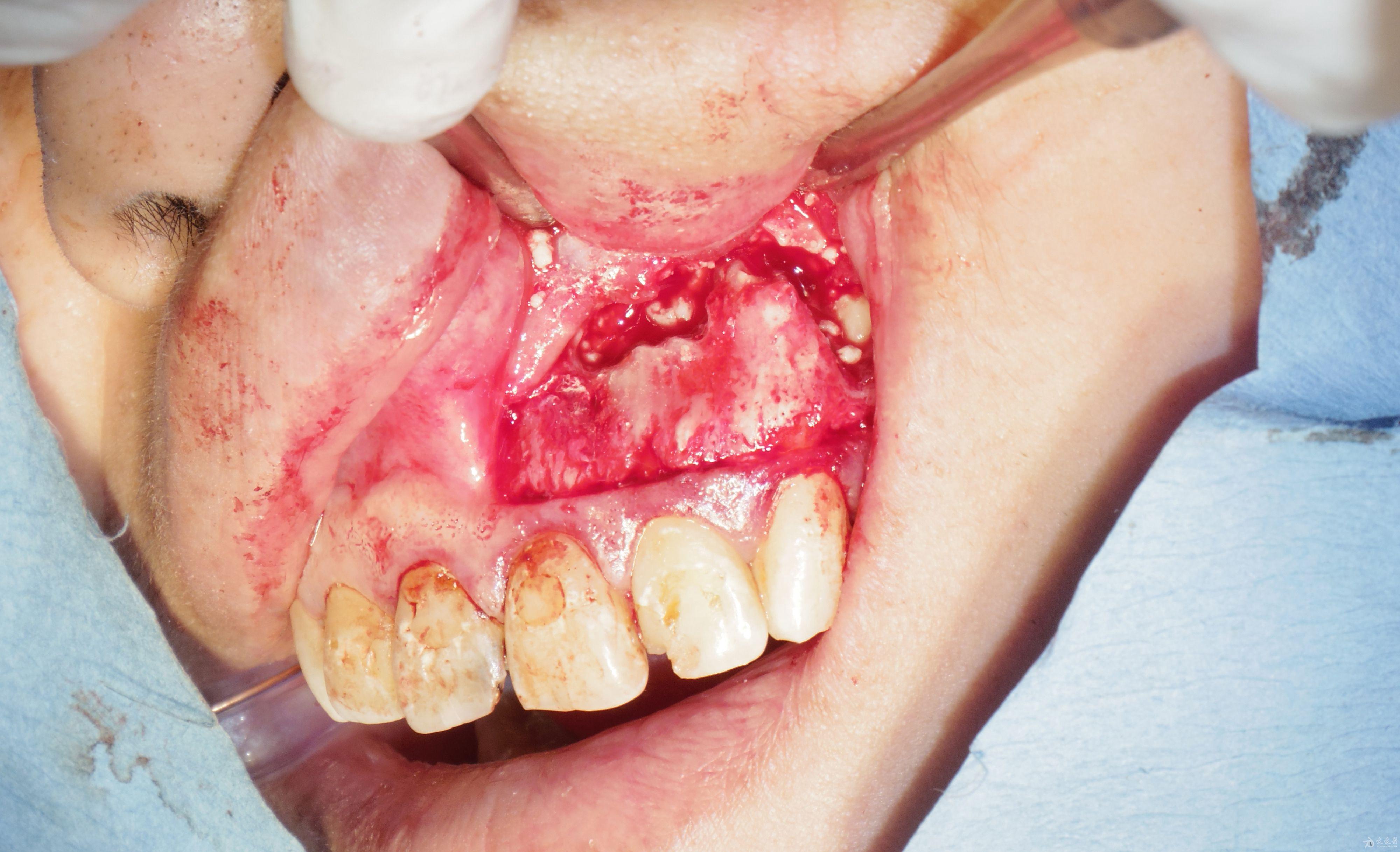 222324根尖切除术及大范围补骨