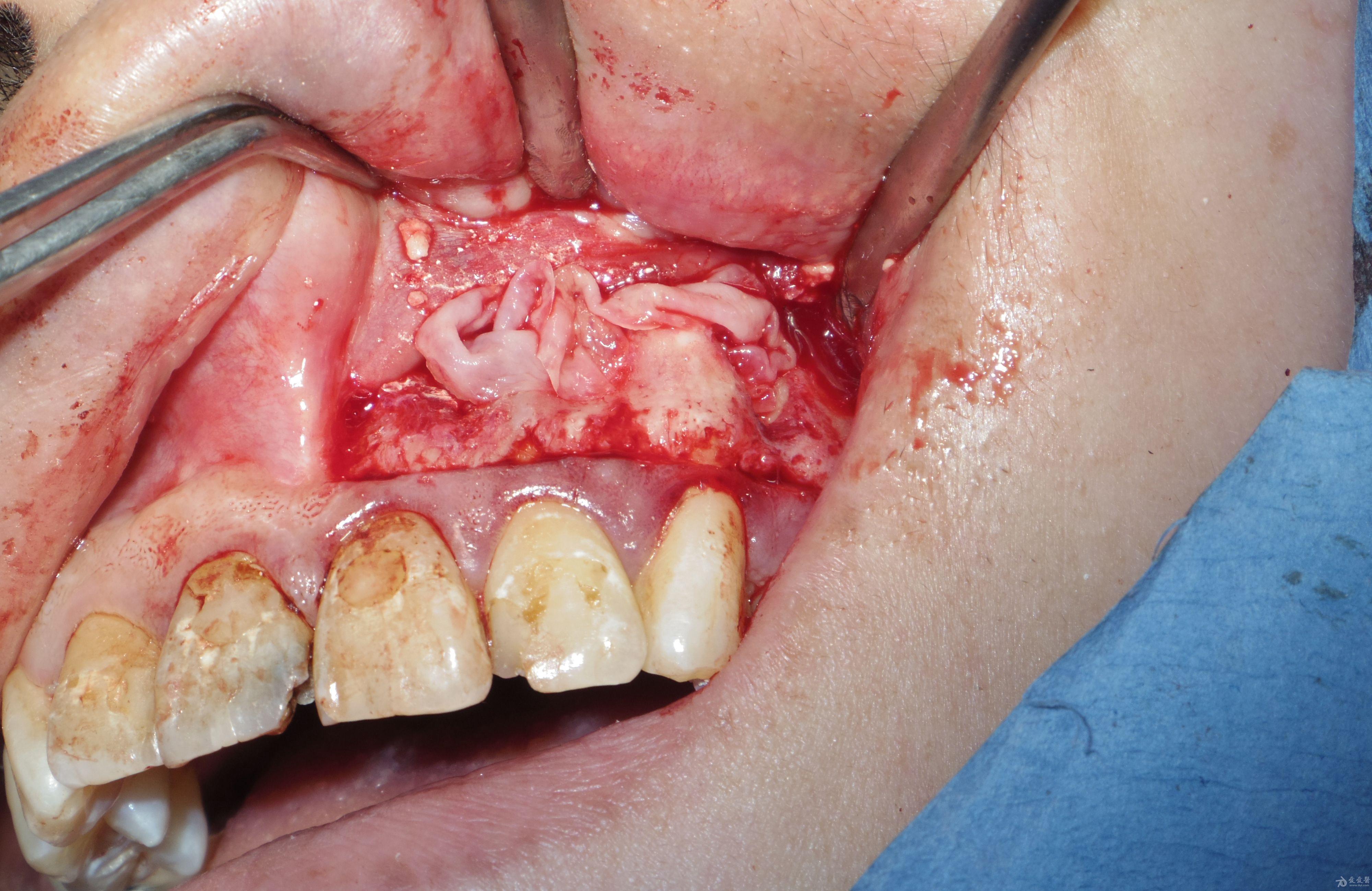 222324根尖切除术及大范围补骨