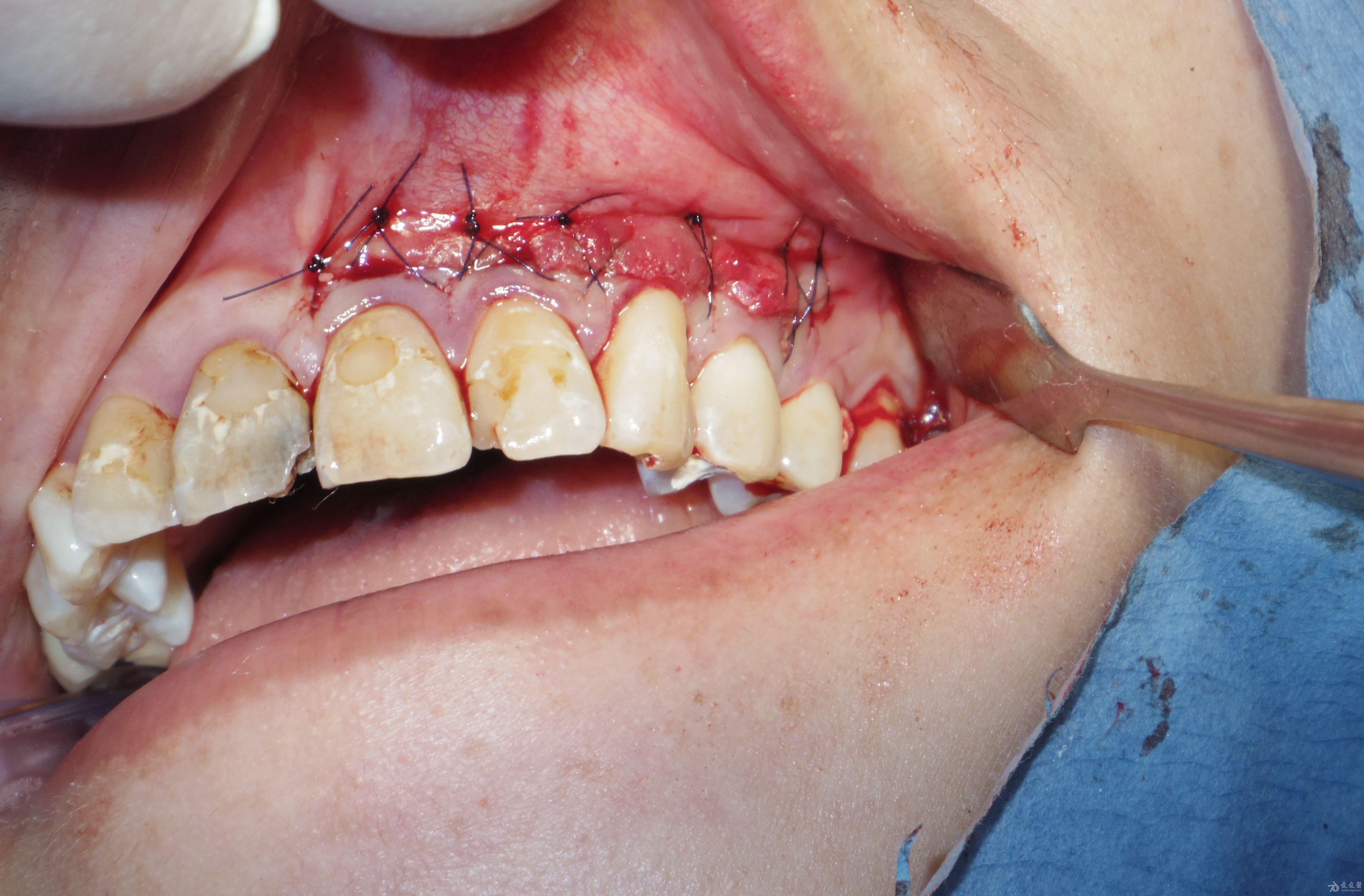 222324根尖切除术及大范围补骨