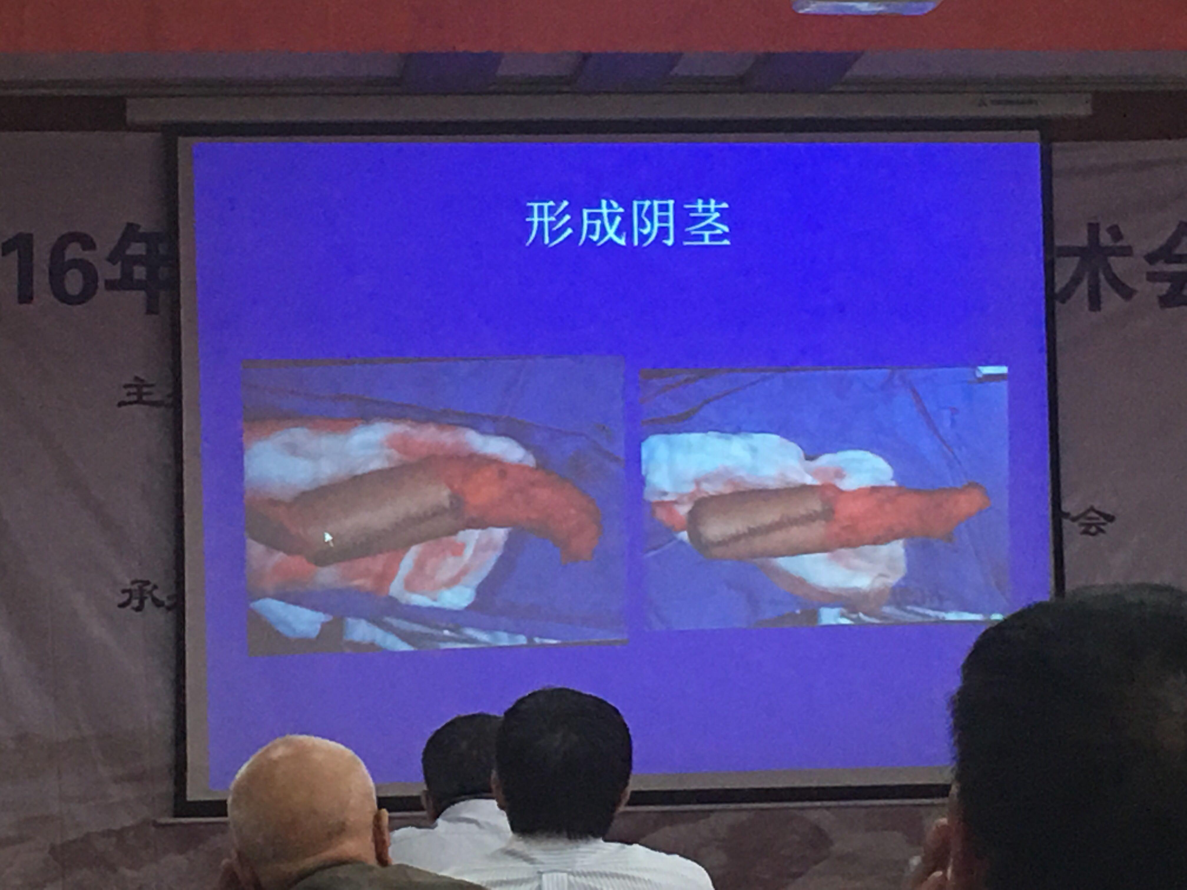 阴茎再造术的一般几种方法