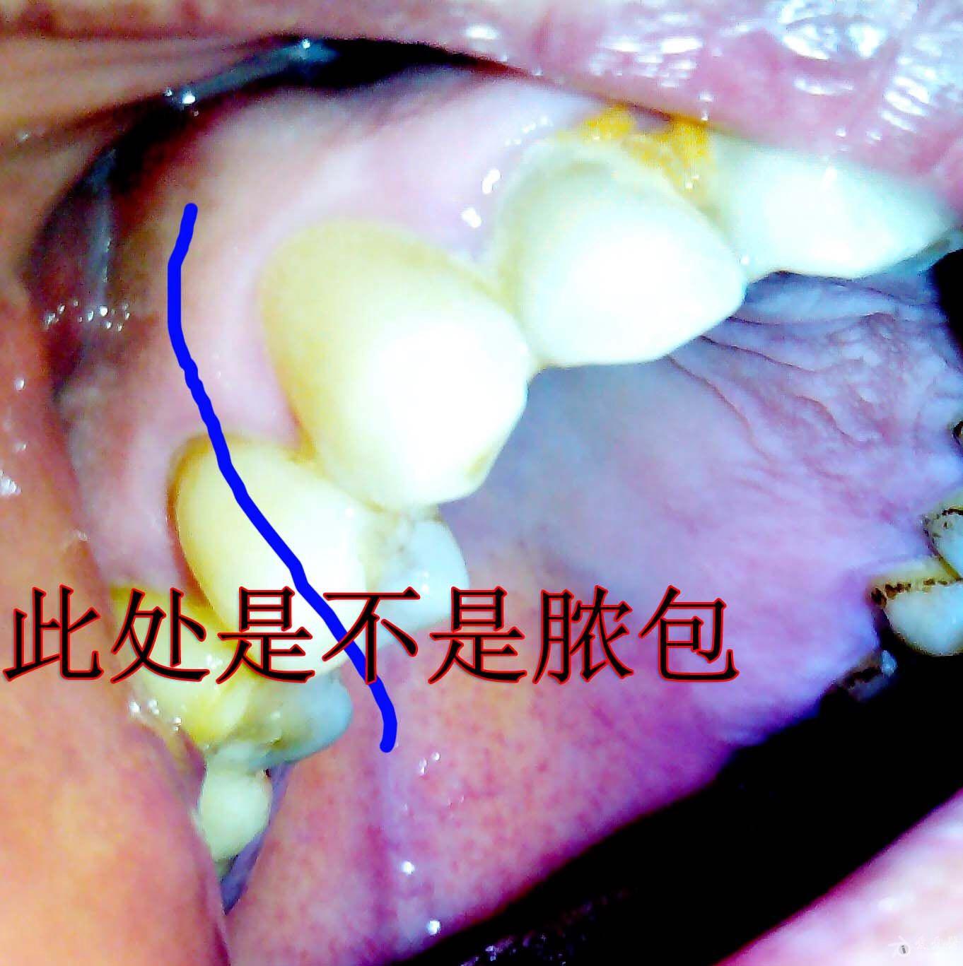 口腔脓栓图片