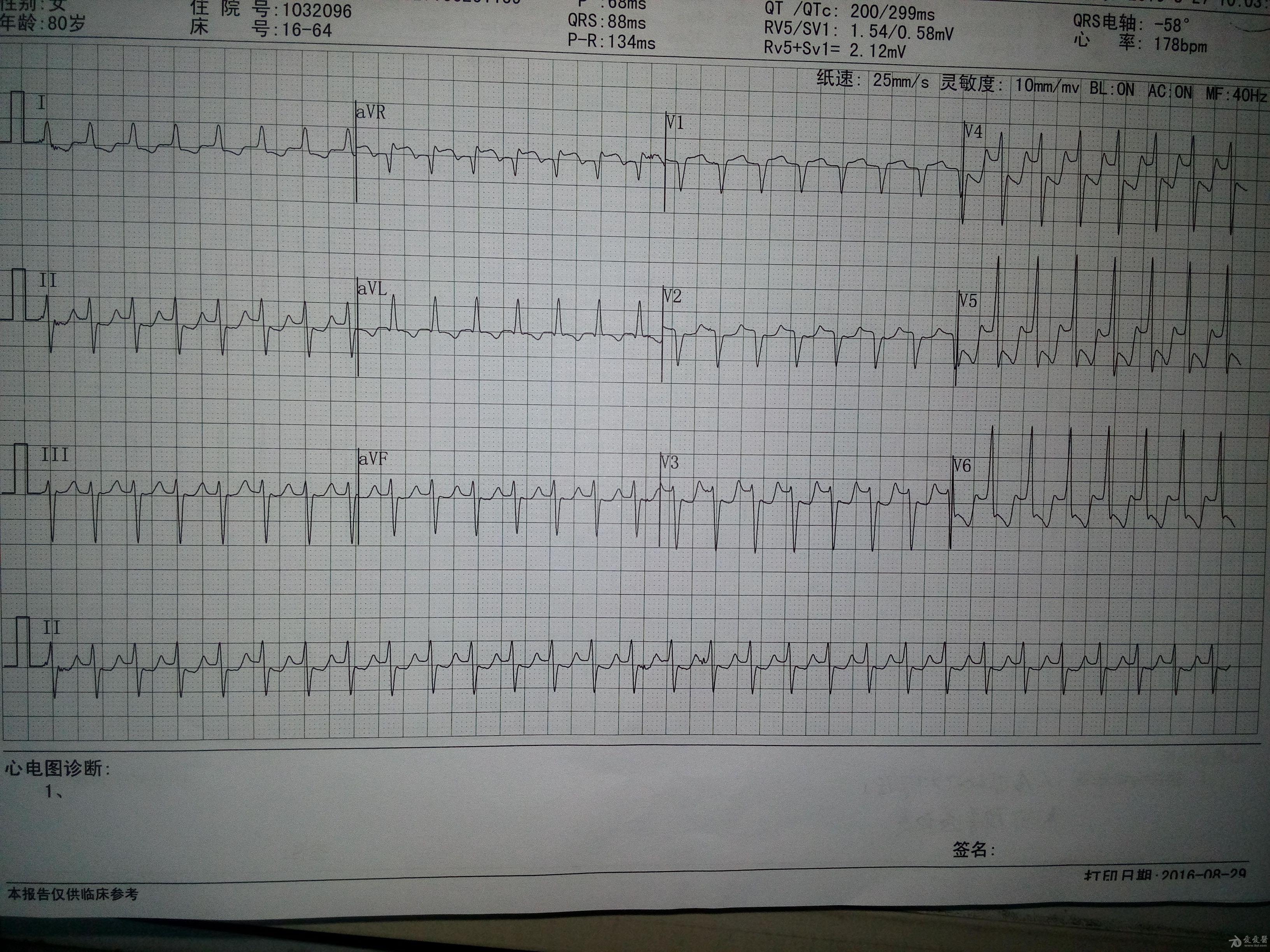 心电图走纸速度和电压图片