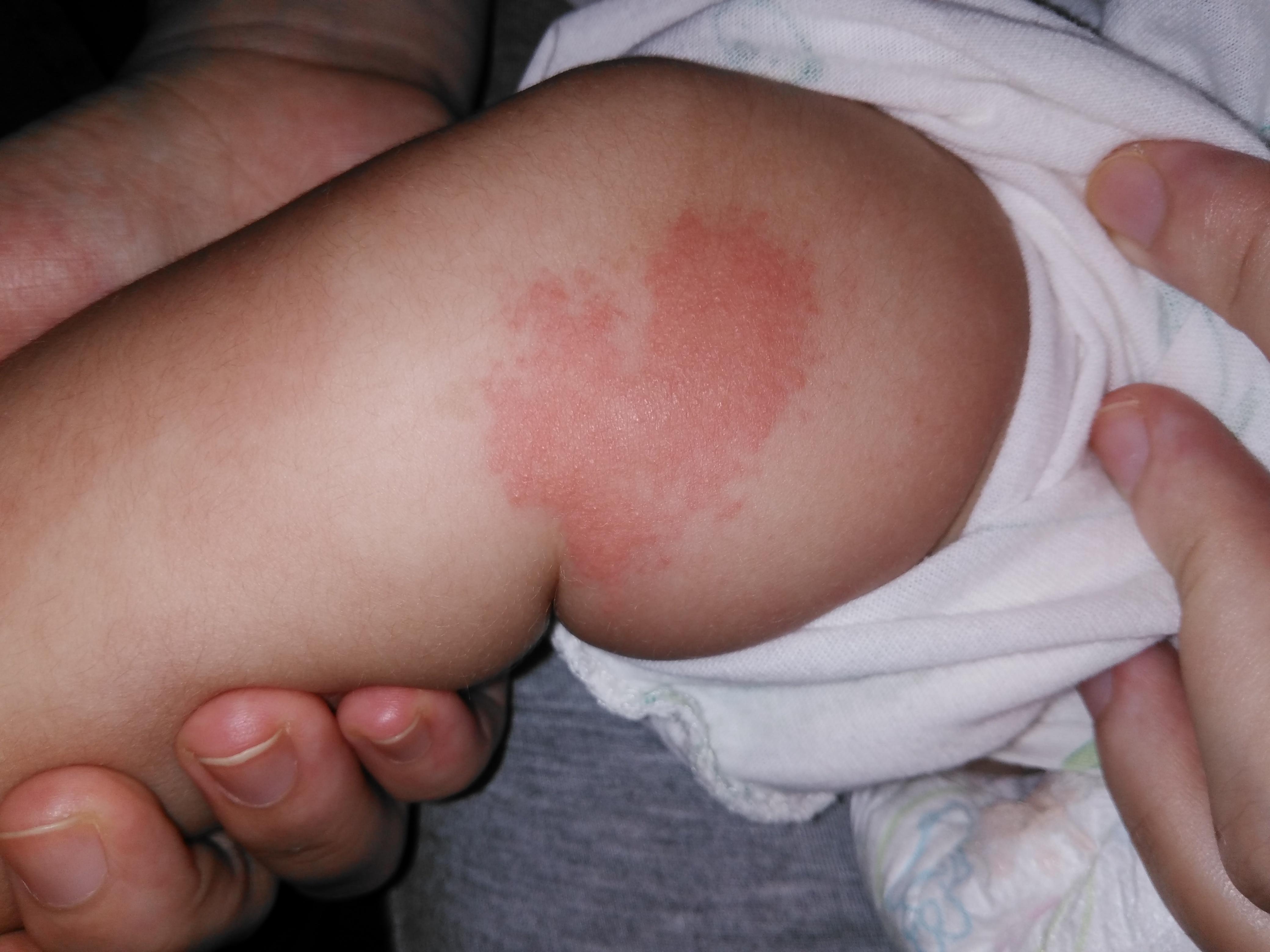 小儿病毒性丘疹的图片图片