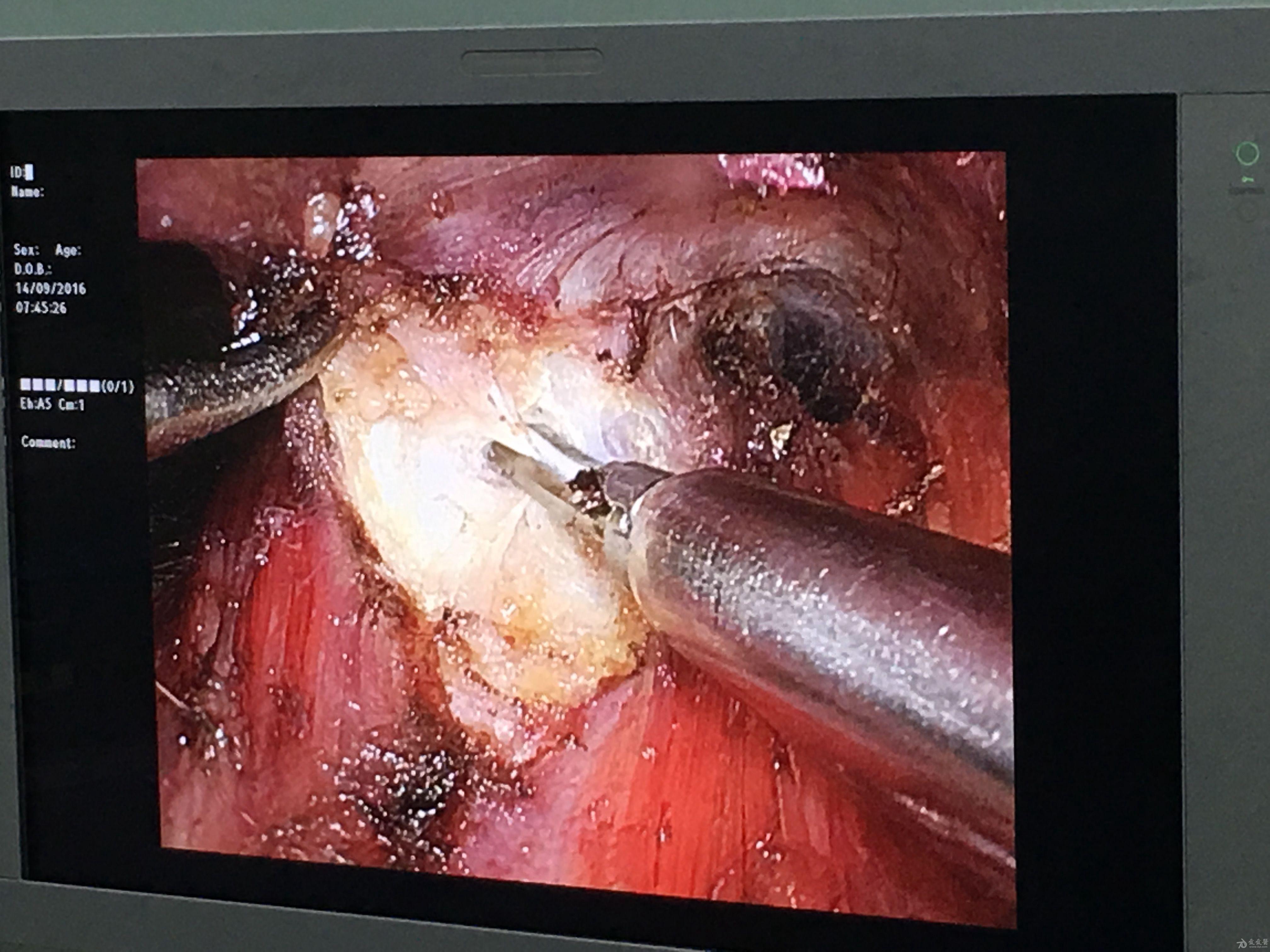 病例讨论腔镜下甲状腺肿物切除术