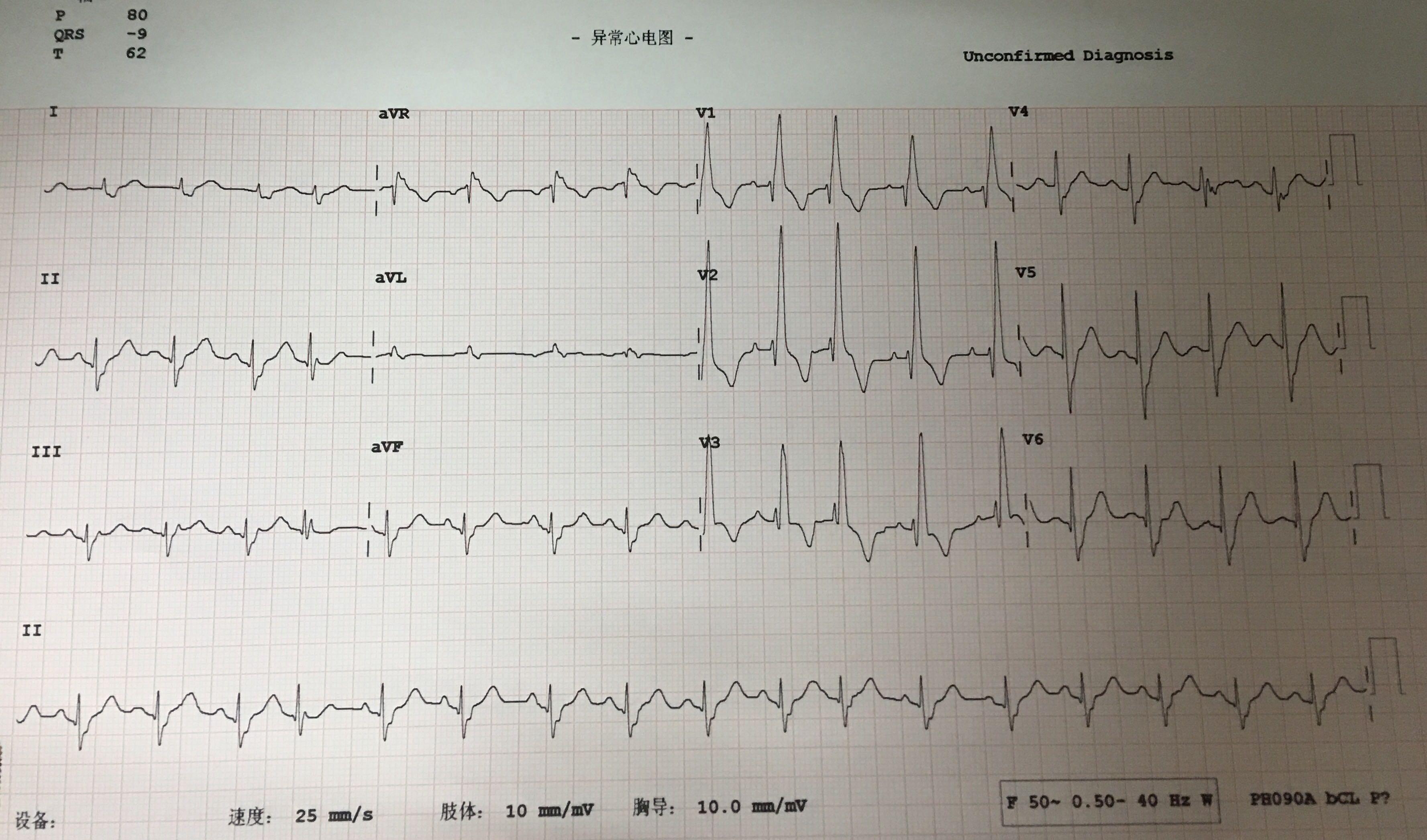 右室心电图图片
