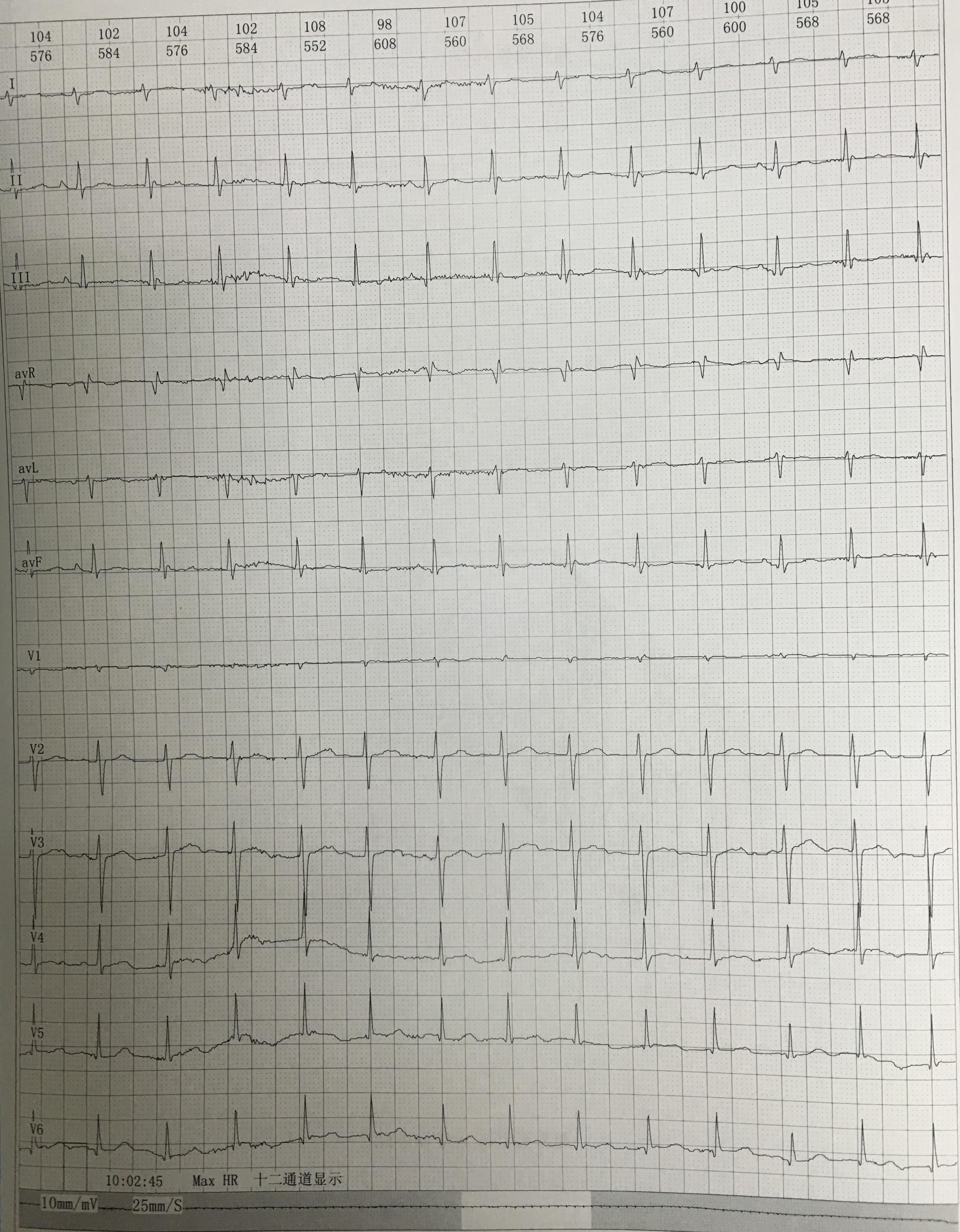 短阵房速心电图图片图片