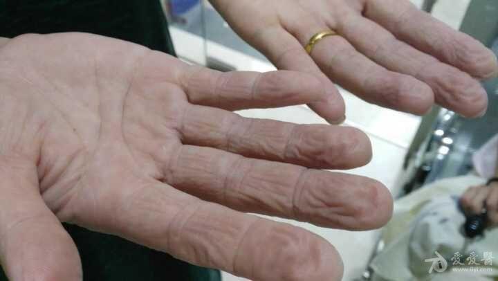 临床经验交流看图诊断水源性肢端角化