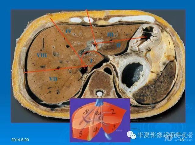 肝的影像学分叶图像图片