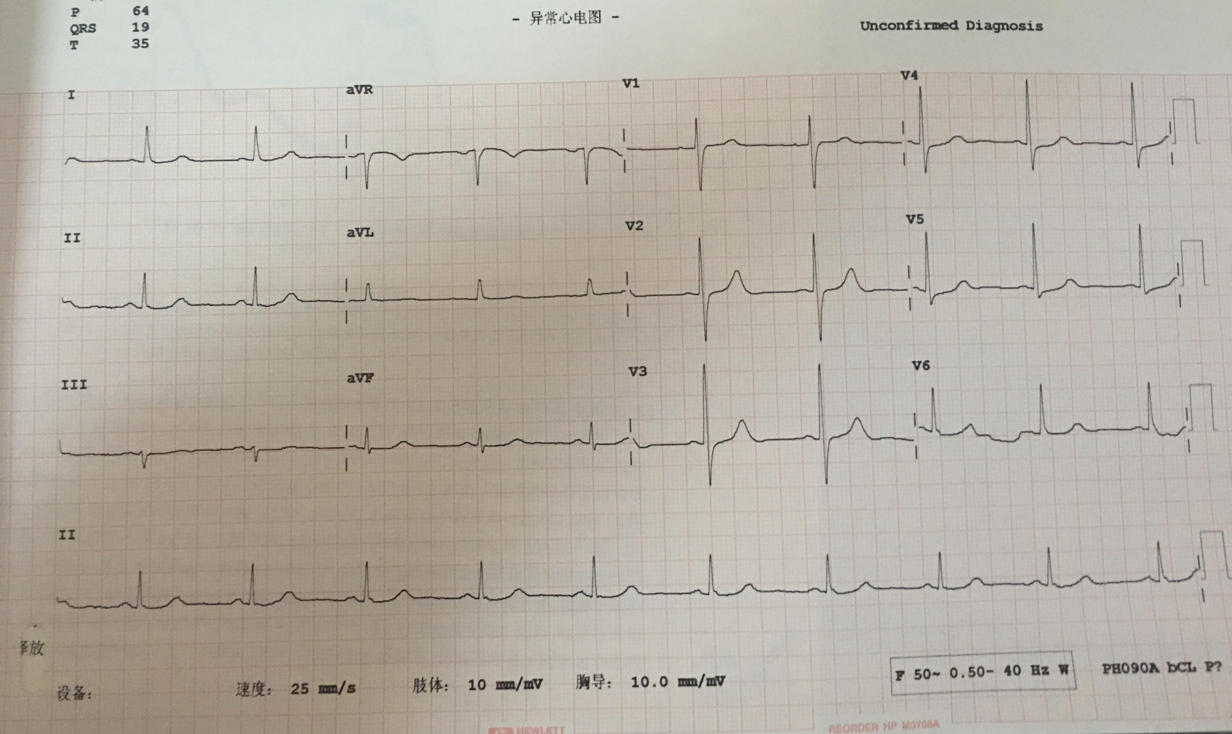 正常心电图v1导联t波图片