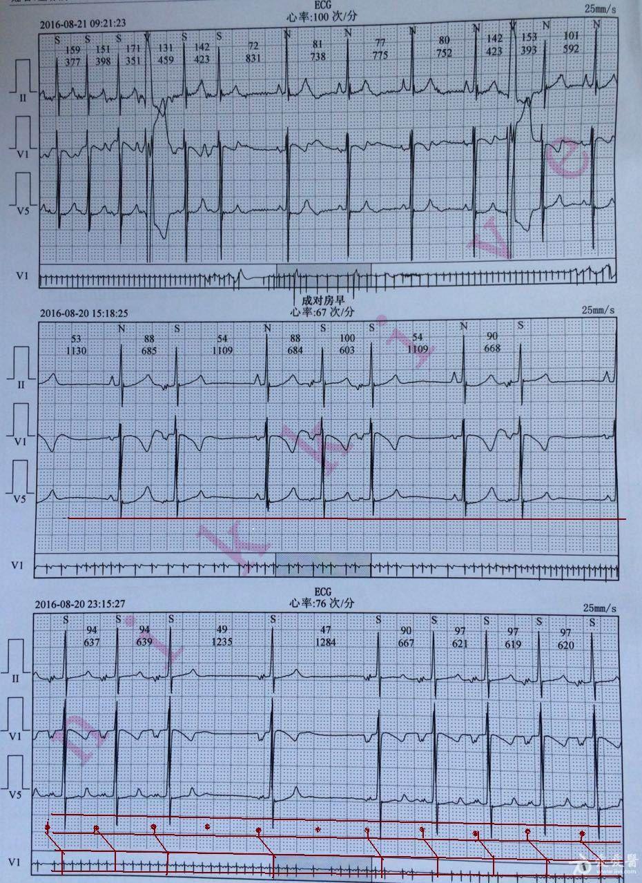 心電圖讀圖60期( 截止2016.10.01)已解密