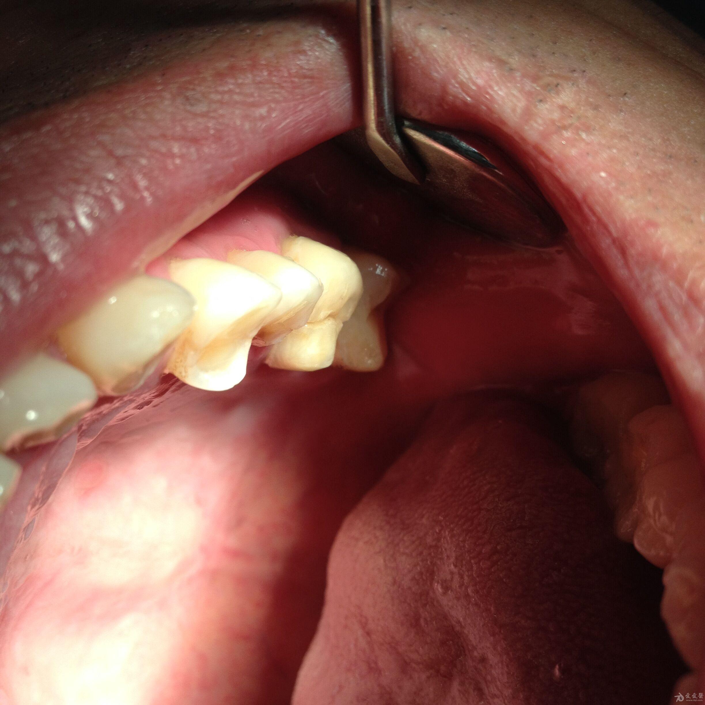 上颌16牙齿劈裂治疗一例