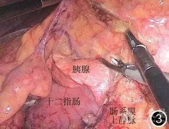 图3 清扫外科干