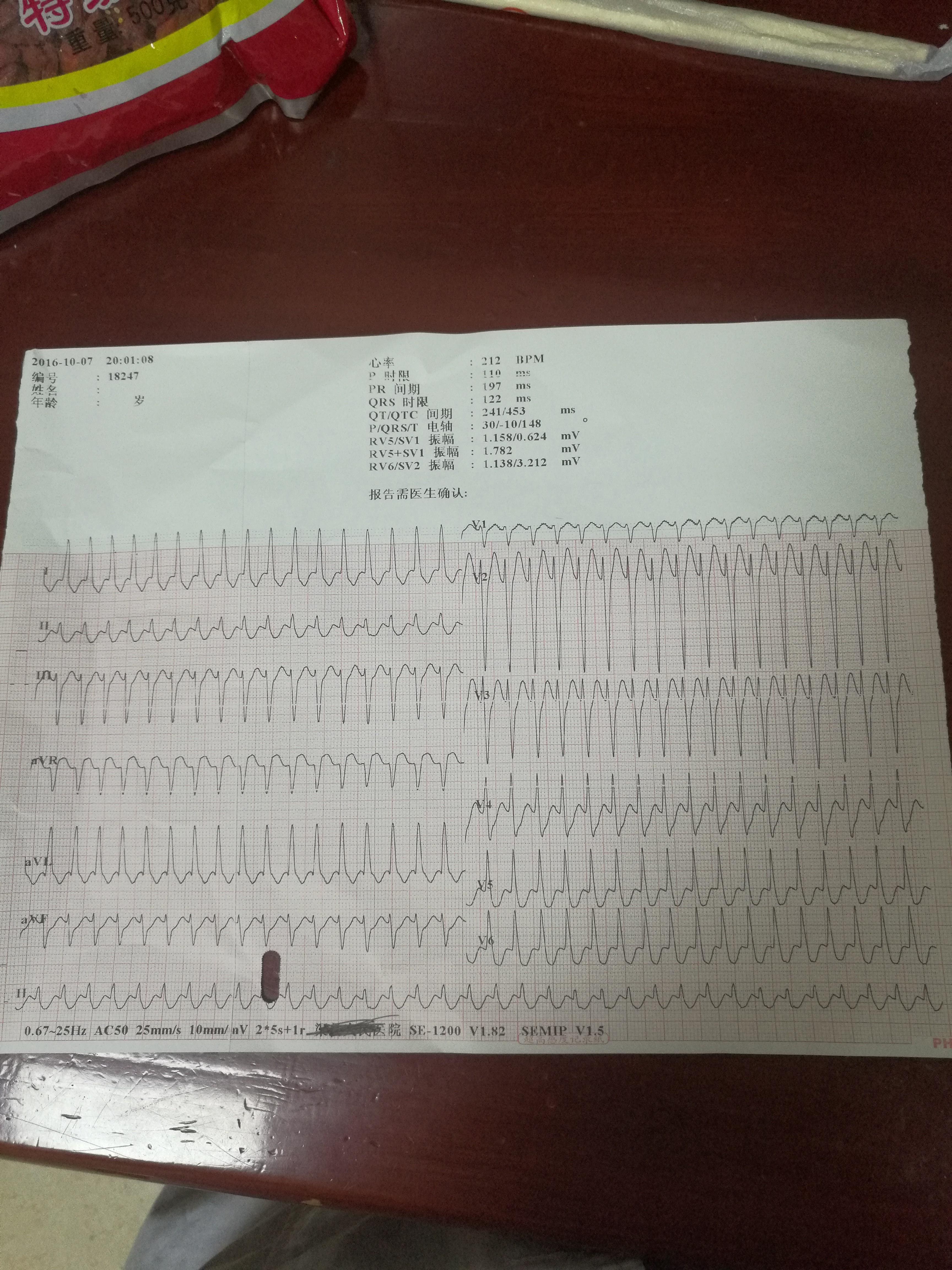 請教各位老師室上速? - 心電圖腦電圖專業討論版 - 愛愛醫醫學論壇