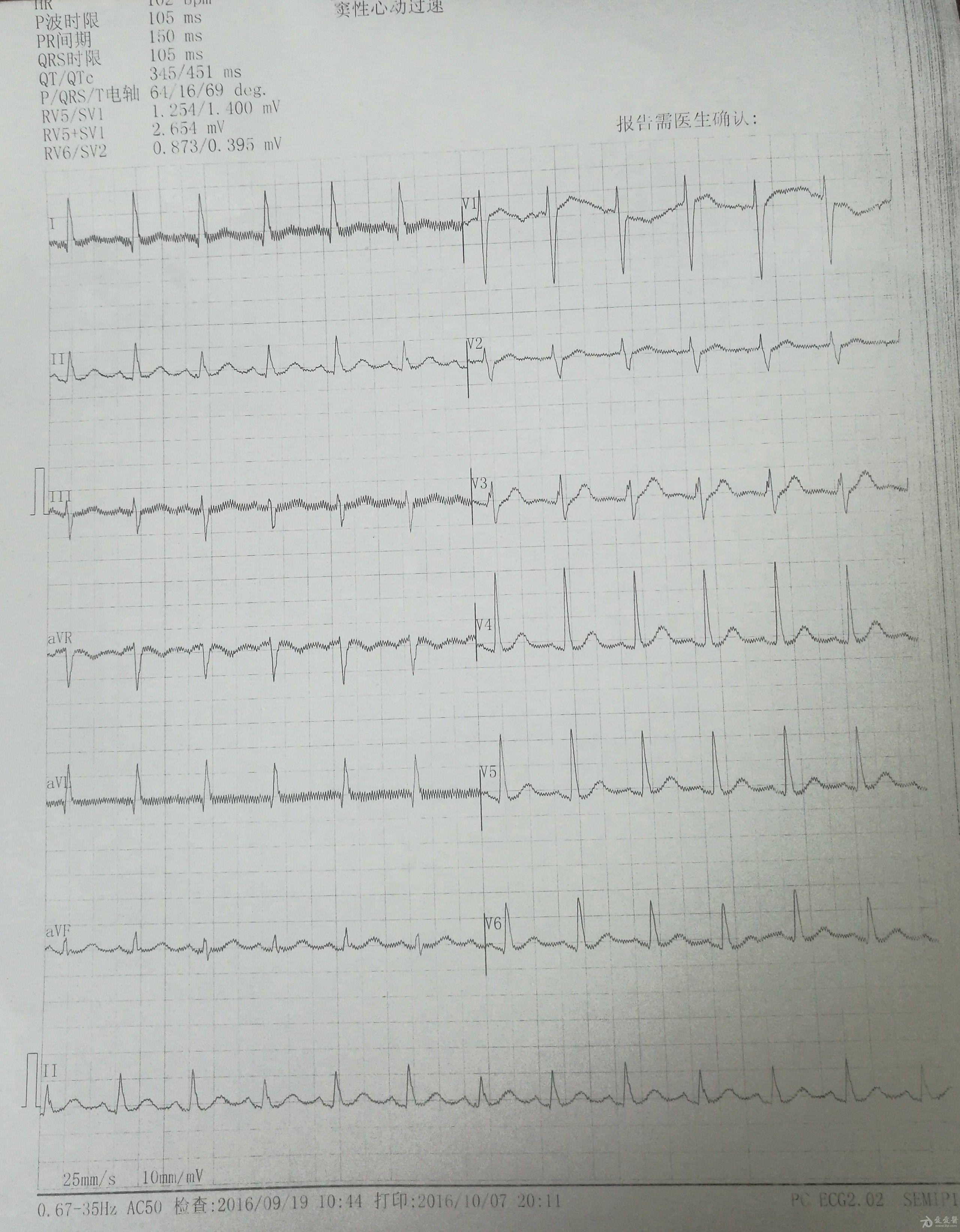 请教各位老师室上速?