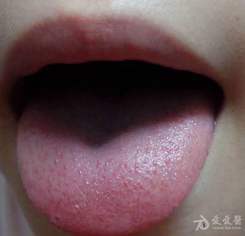 舌头尖有小红点图片图片