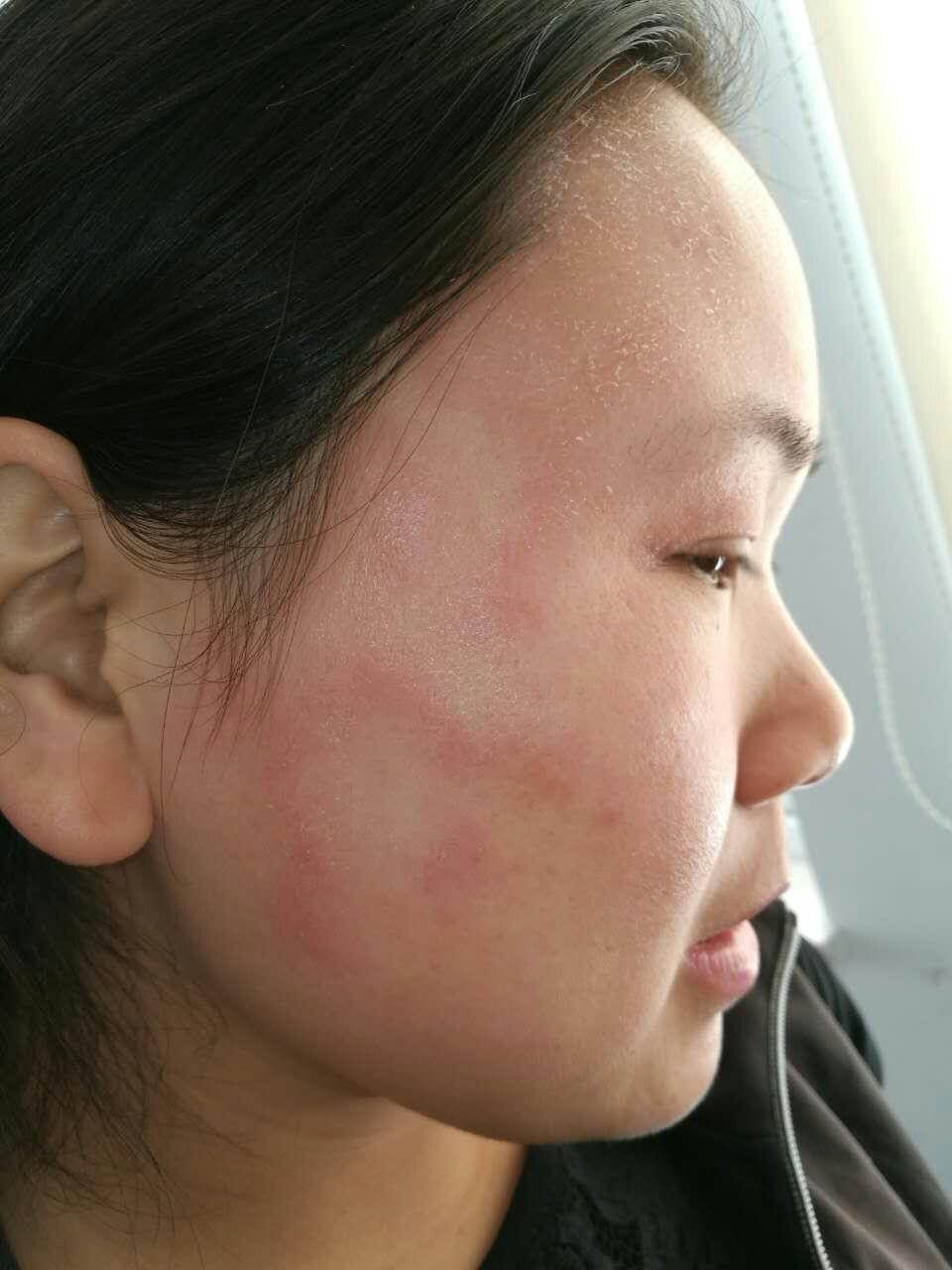 请教老师这是接触性皮炎吧 - 皮肤及性传播疾病讨论版 - 爱爱医医学