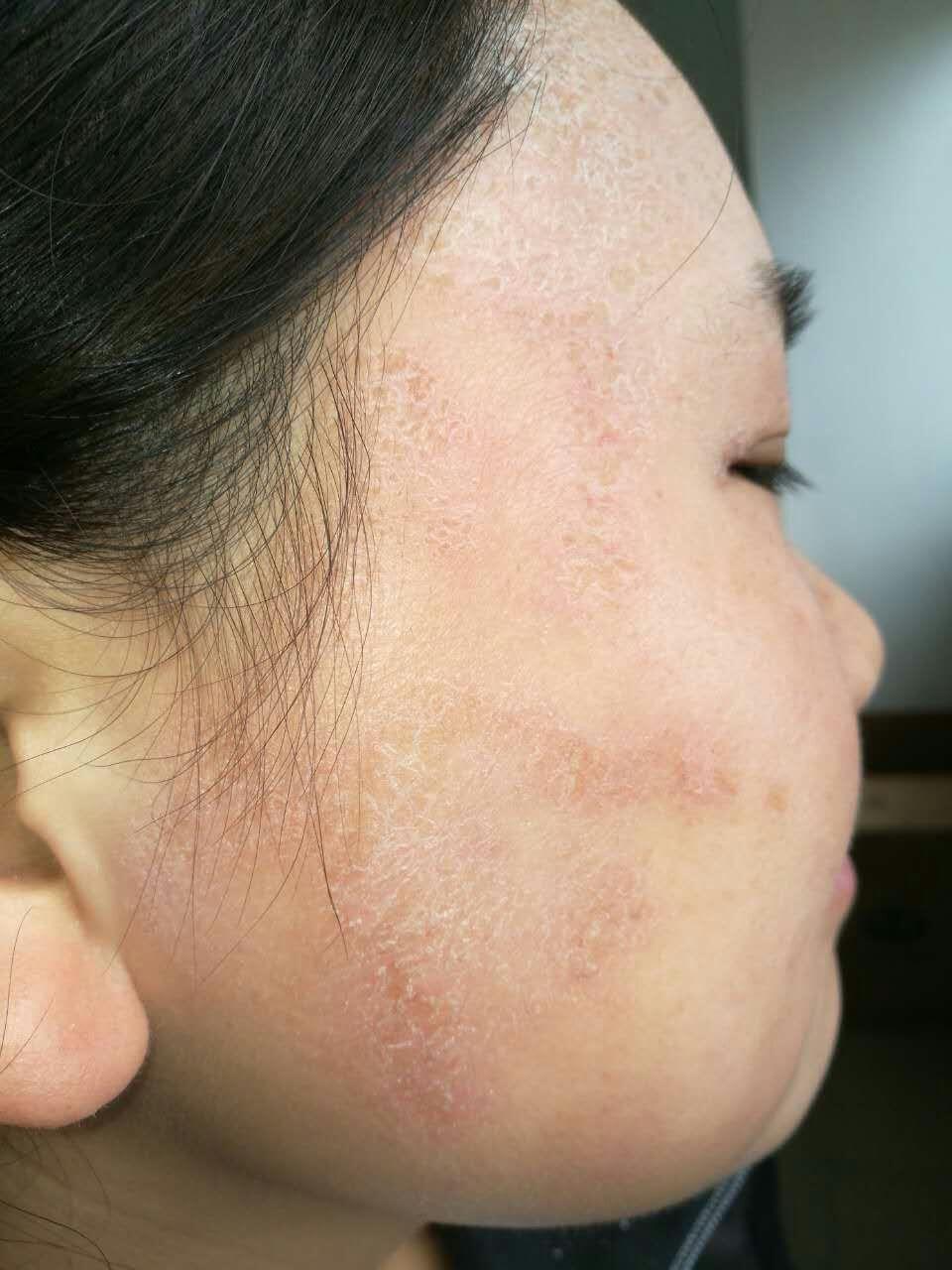 请教老师这是接触性皮炎吧