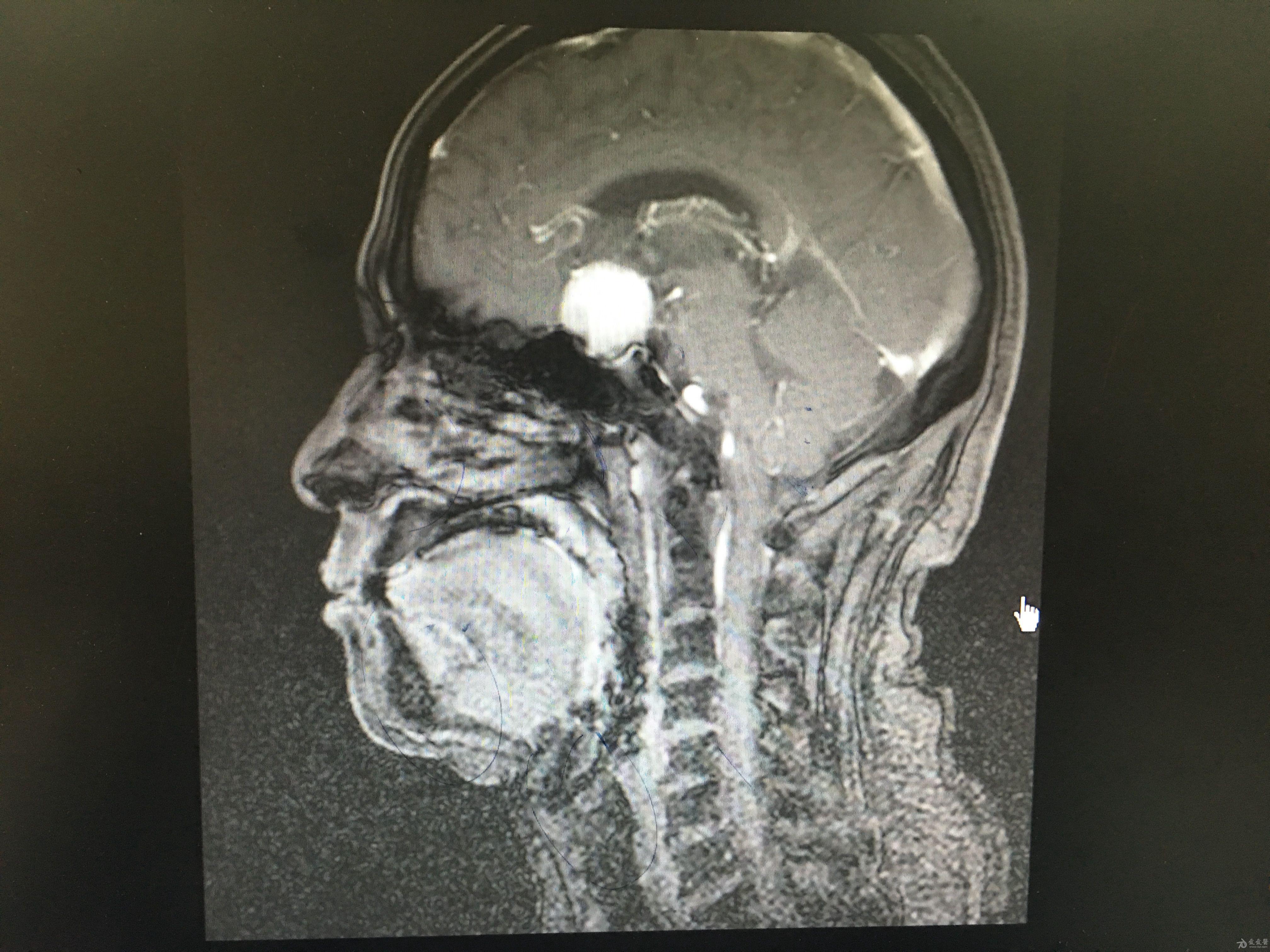 分享一例鞍区脑膜瘤手术病例原创