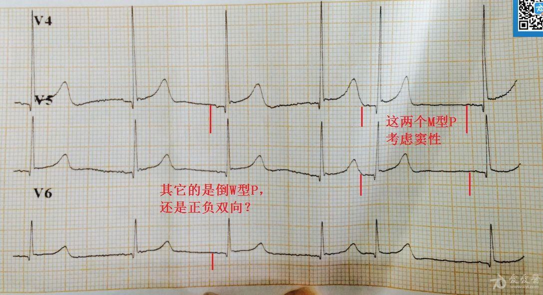 請各位老師幫我看下這張心電圖
