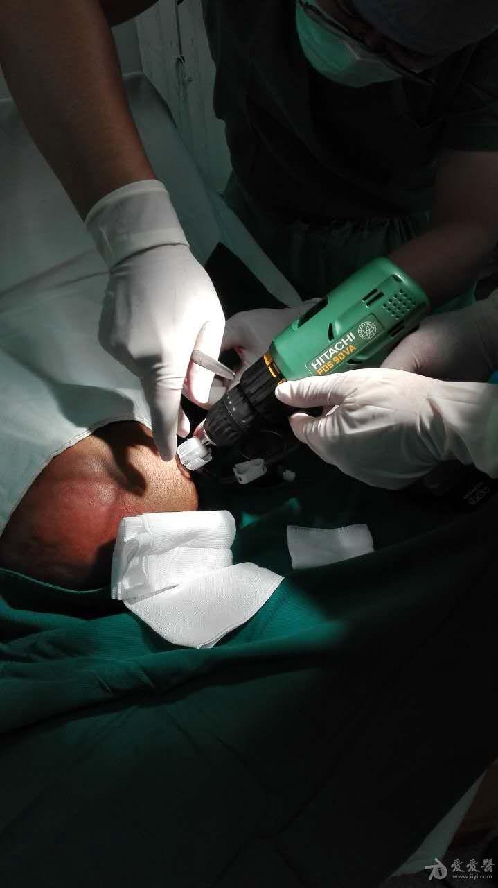 分享一例亚急性硬膜下血肿微创病例(原创)