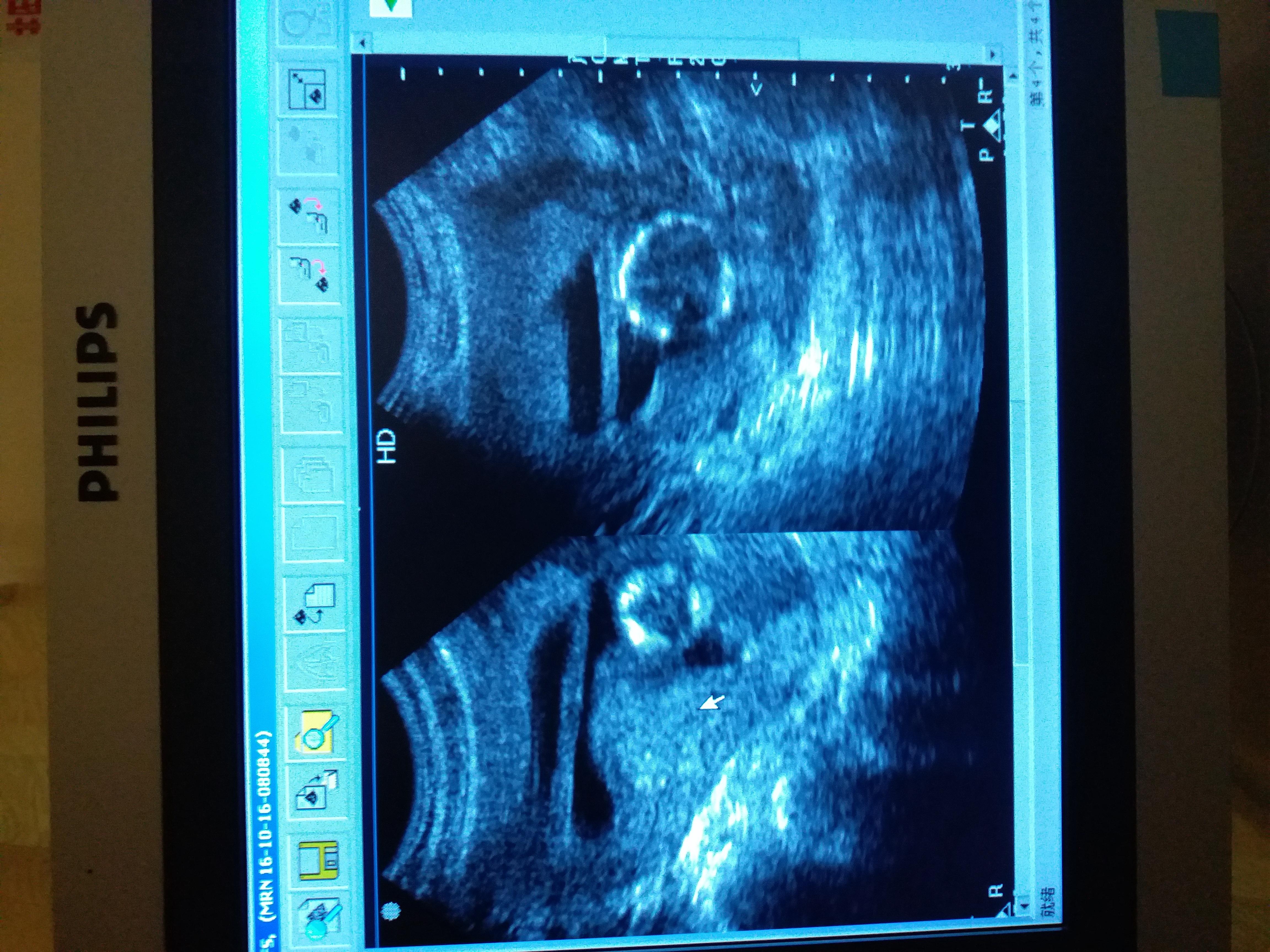 这是轮状胎盘吗?这个多见吗? - 超声医学讨论版 - 爱爱医医学论坛